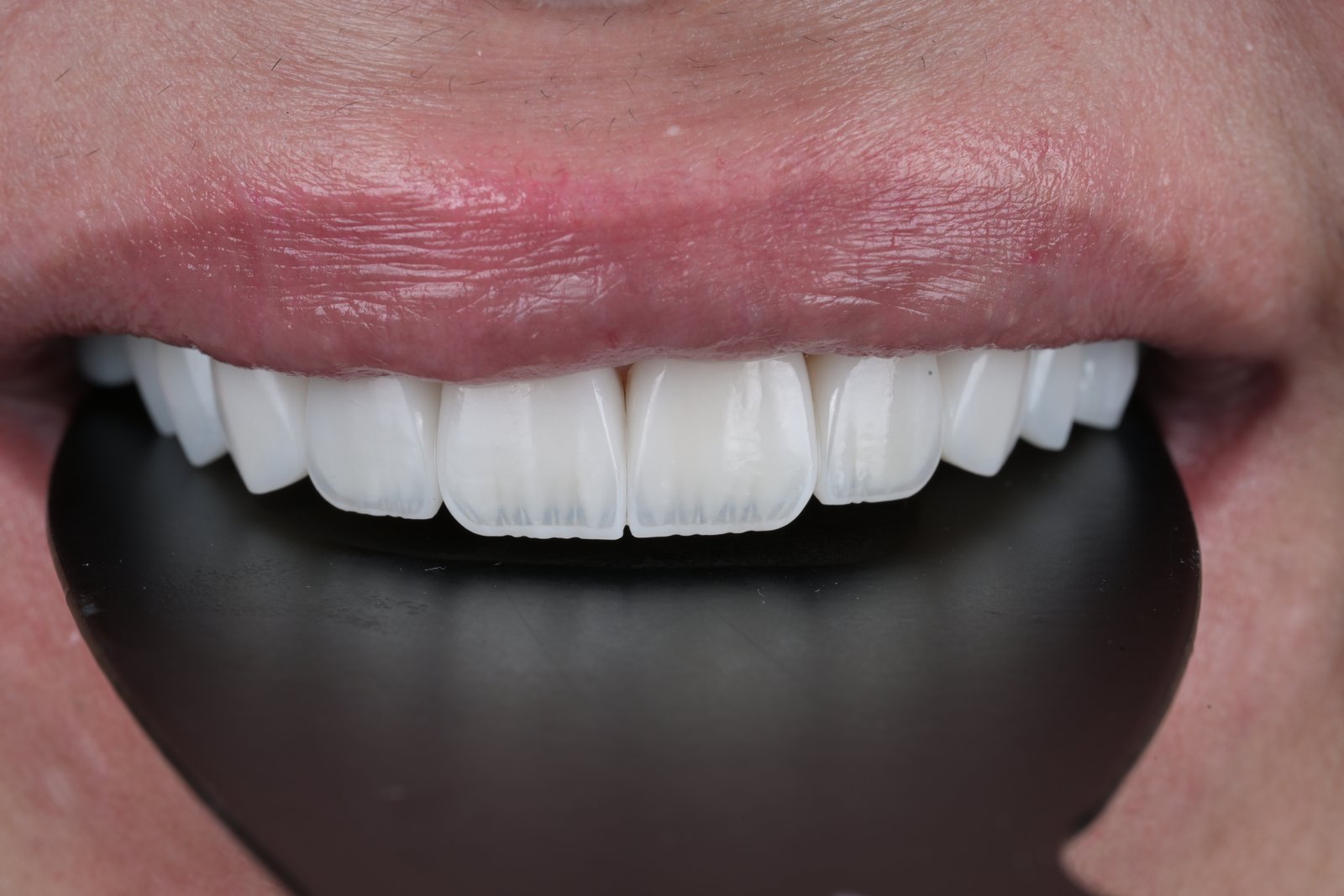 After treatment
