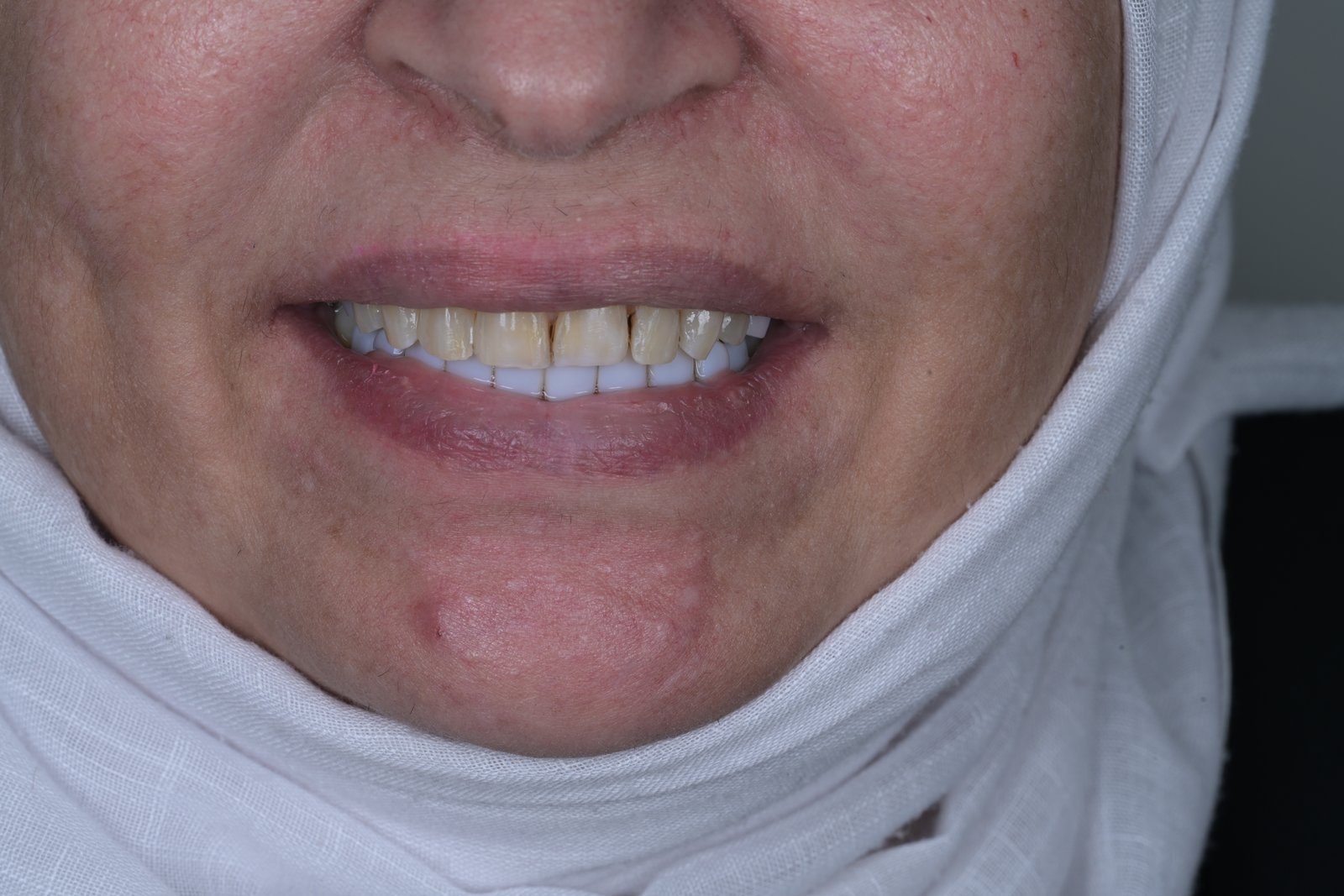 Before treatment