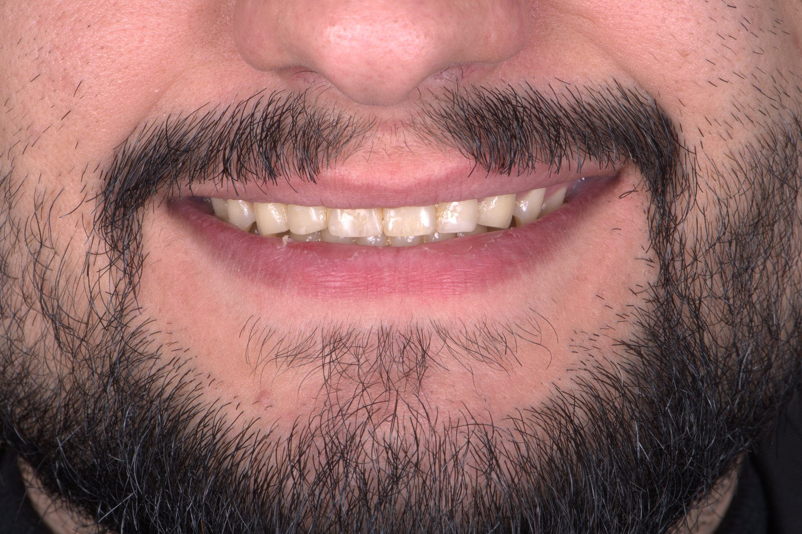 Before treatment