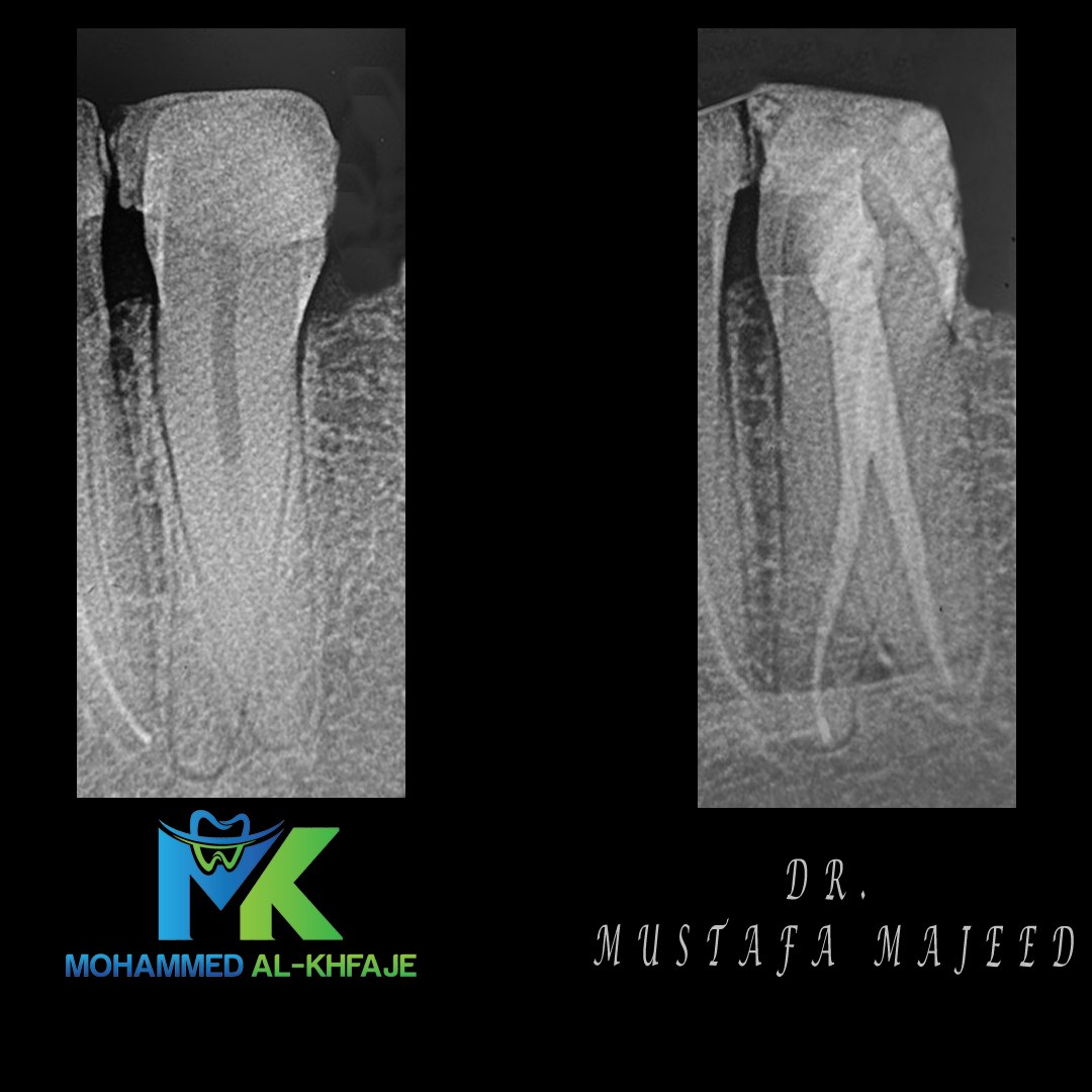 Endodontic case radiograph — Dr. Mustafa Majeed