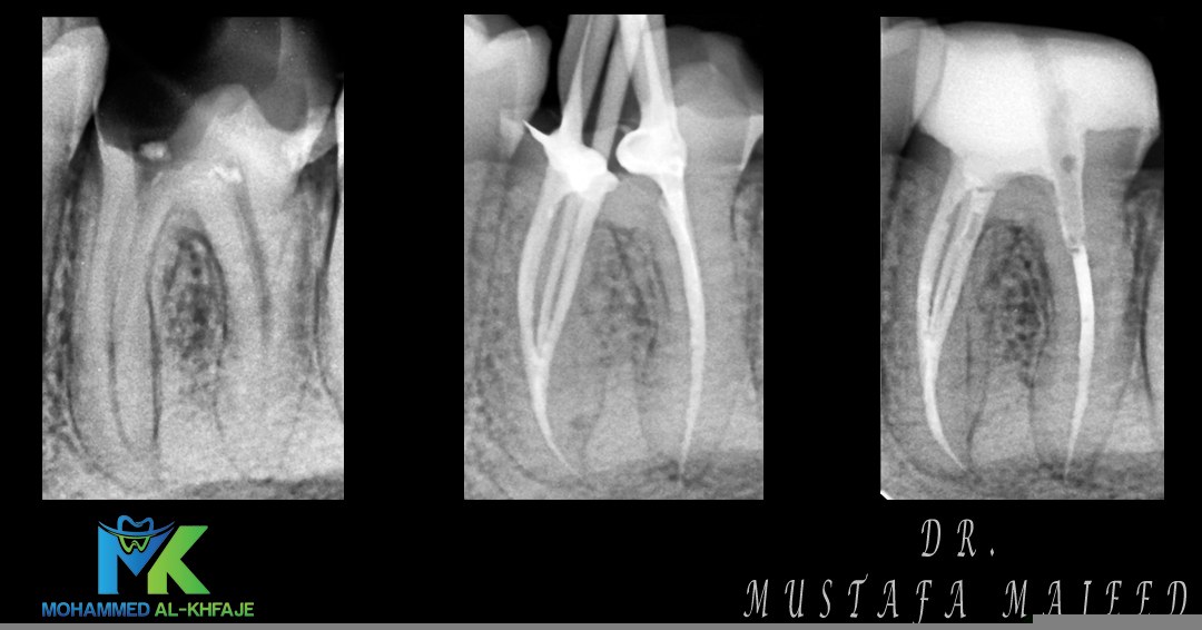 Endodontic case radiograph — Dr. Mustafa Majeed