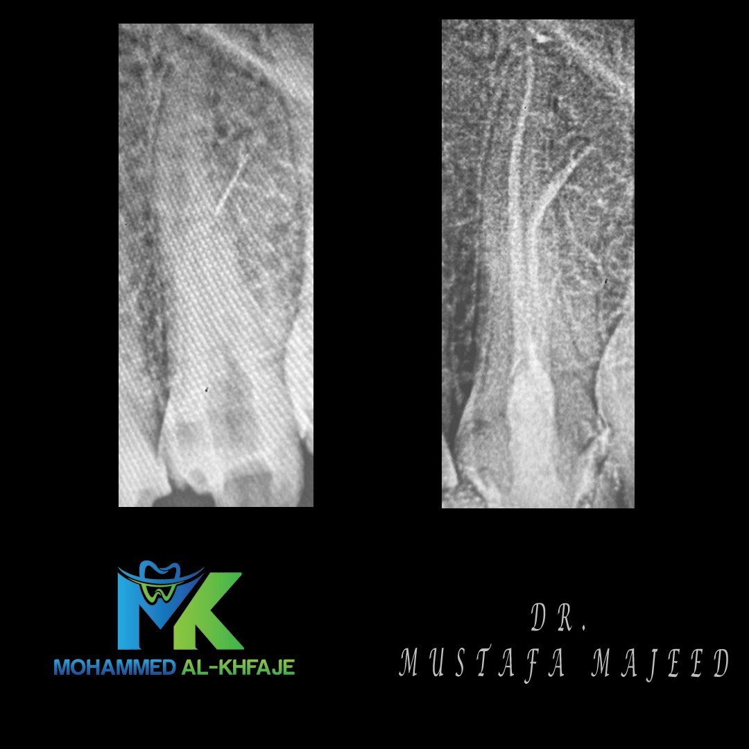 Endodontic case radiograph — Dr. Mustafa Majeed