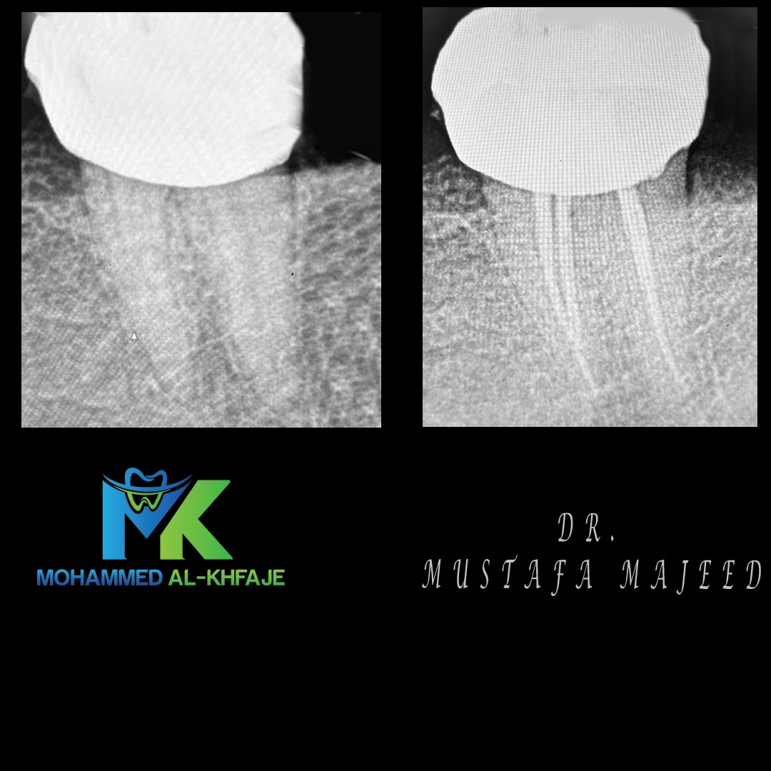 Endodontic case radiograph — Dr. Mustafa Majeed