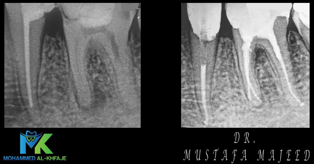 Endodontic case radiograph — Dr. Mustafa Majeed