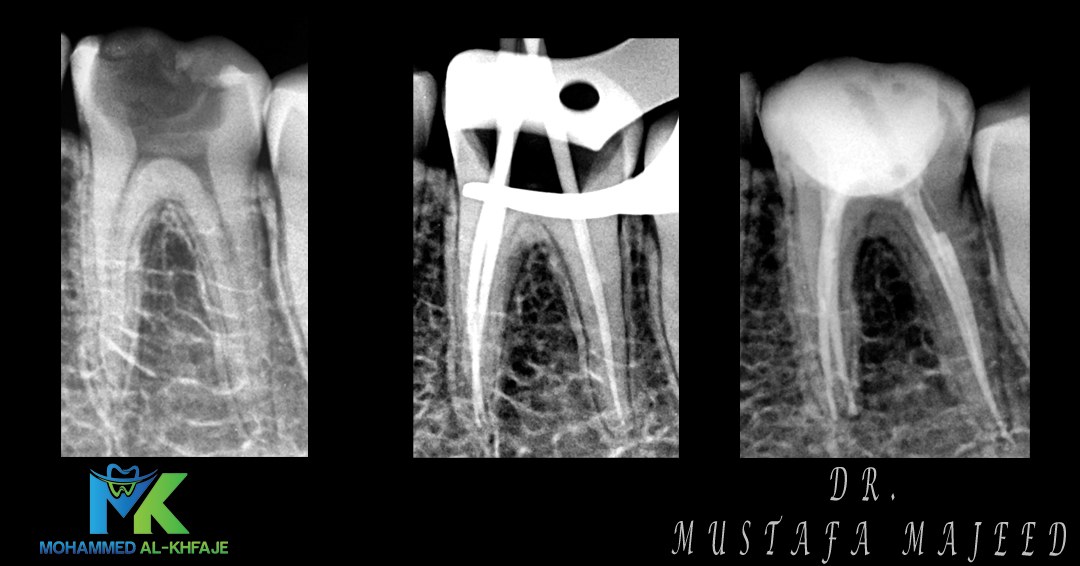 Endodontic case radiograph — Dr. Mustafa Majeed