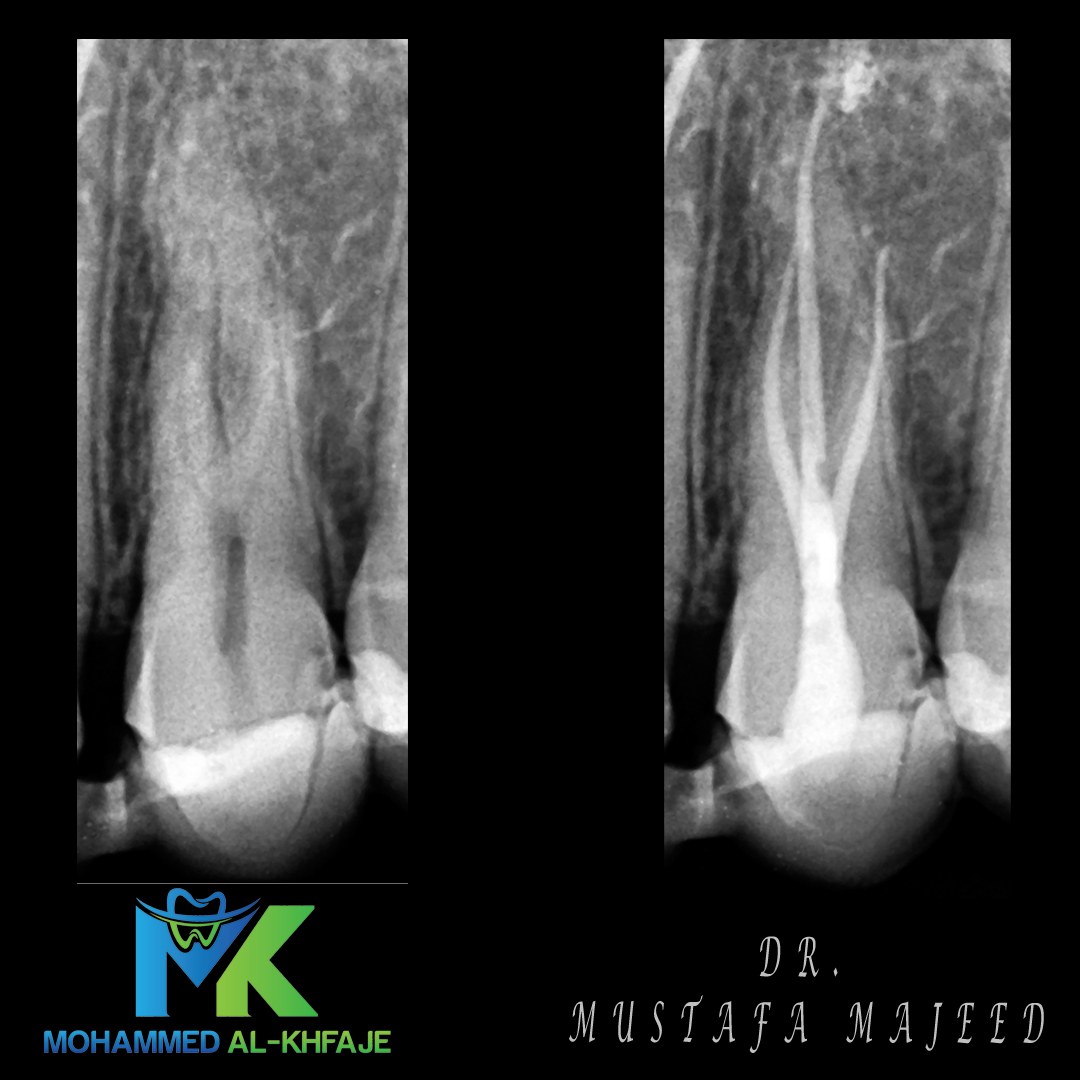 Endodontic case radiograph — Dr. Mustafa Majeed