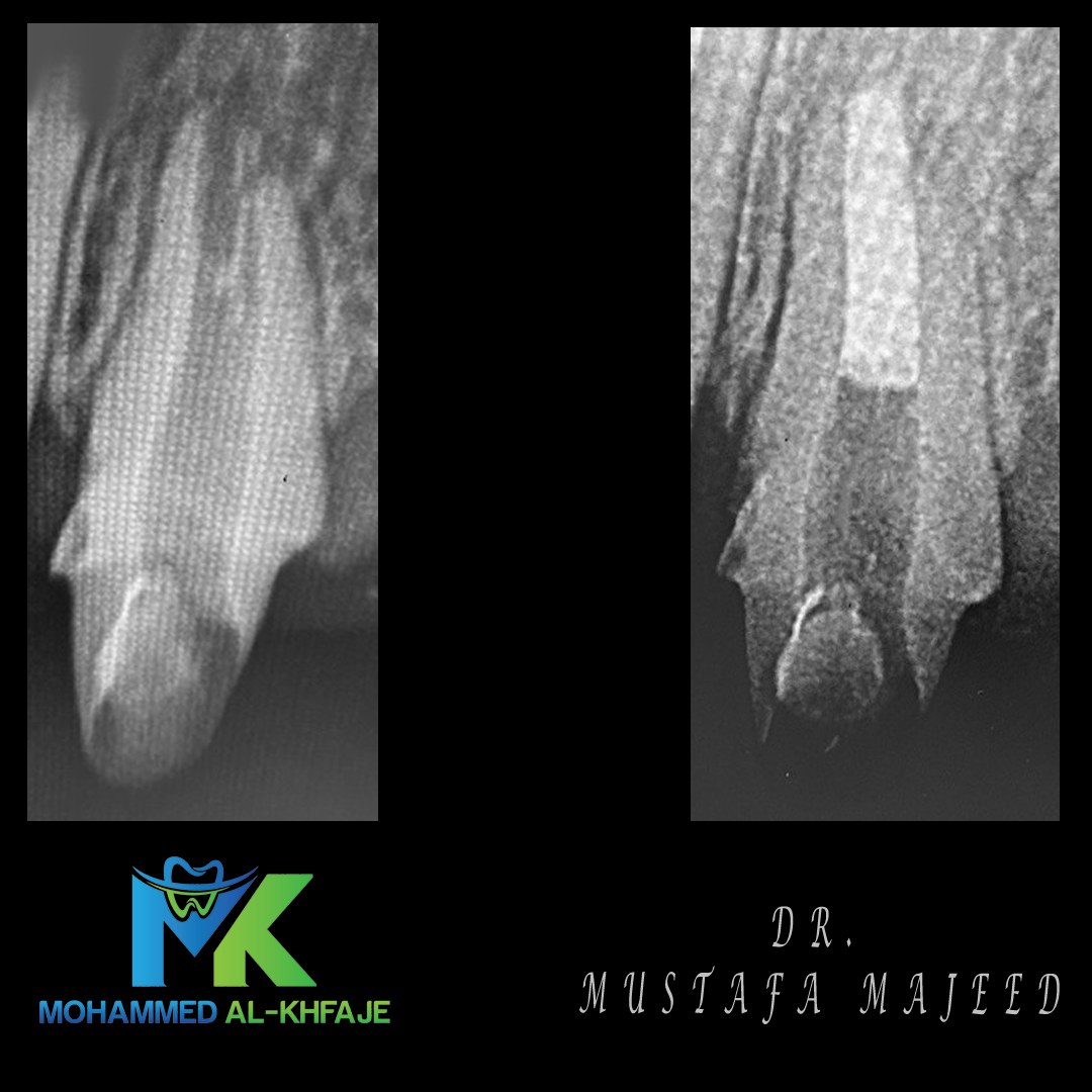 Endodontic case radiograph — Dr. Mustafa Majeed
