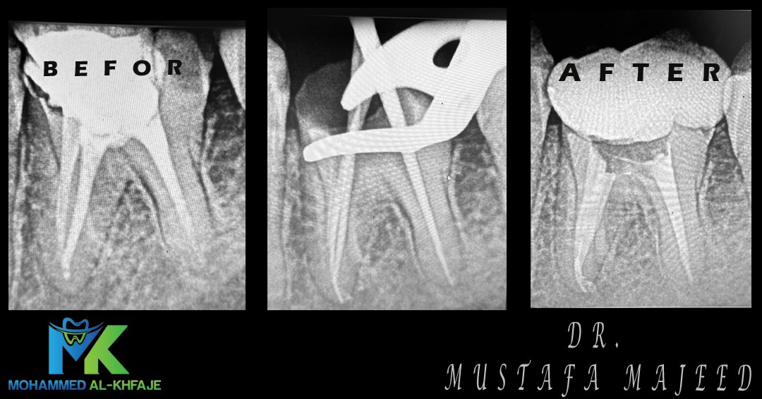 Endodontic case radiograph — Dr. Mustafa Majeed