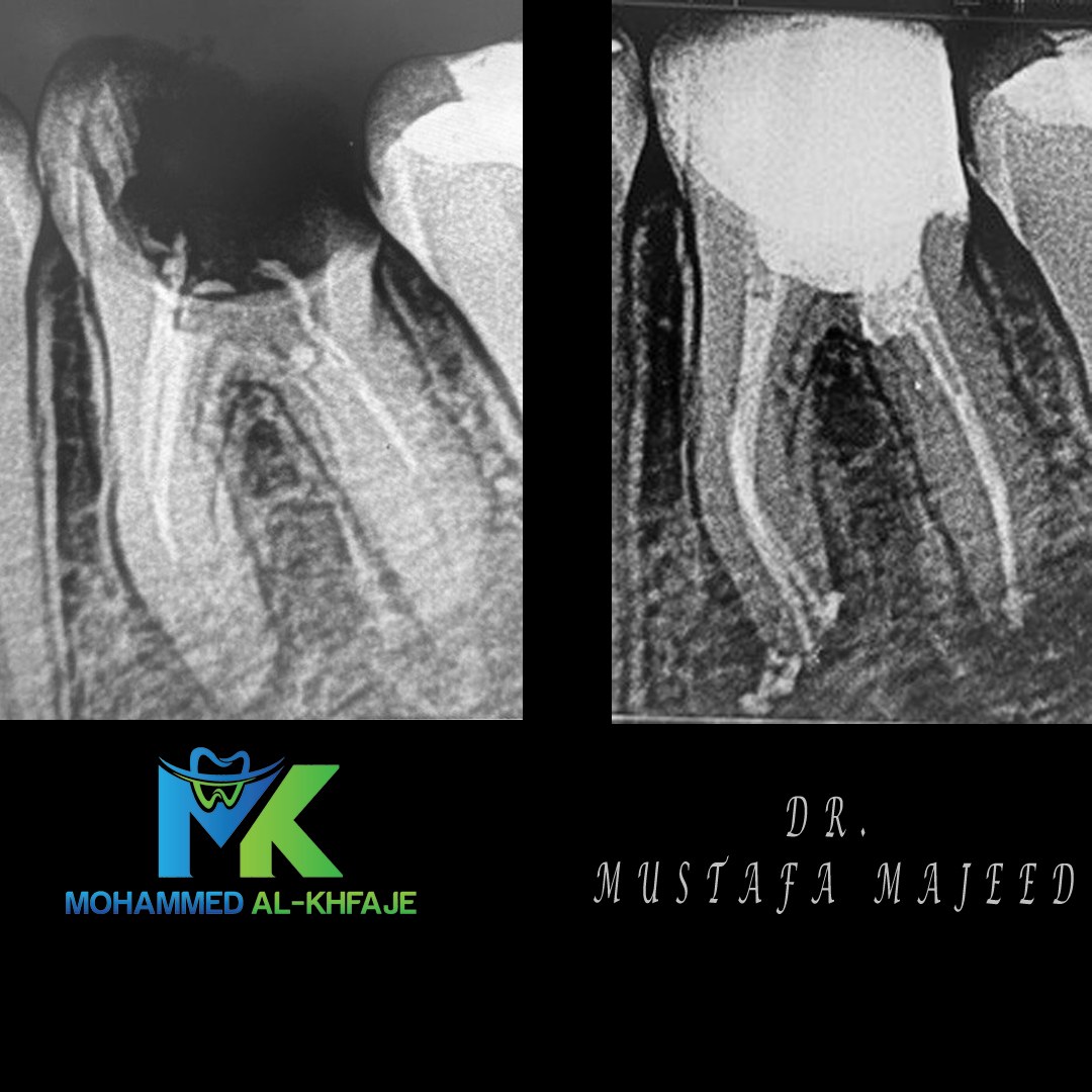 Endodontic case radiograph — Dr. Mustafa Majeed