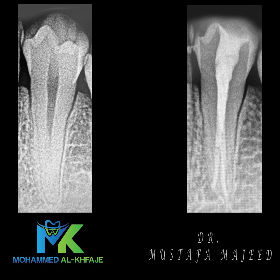 Endodontic case radiograph — Dr. Mustafa Majeed