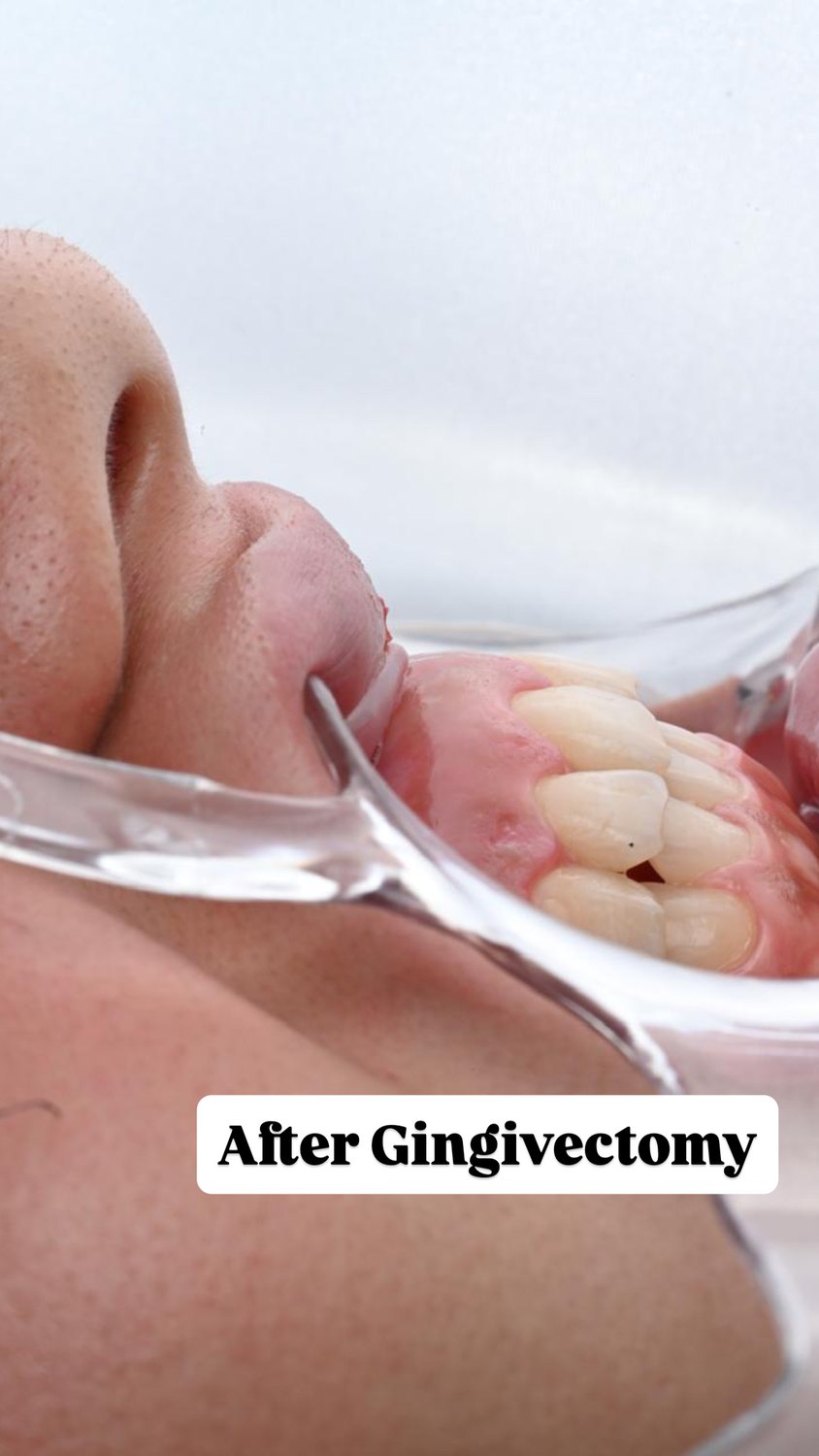After — Gingivectomy