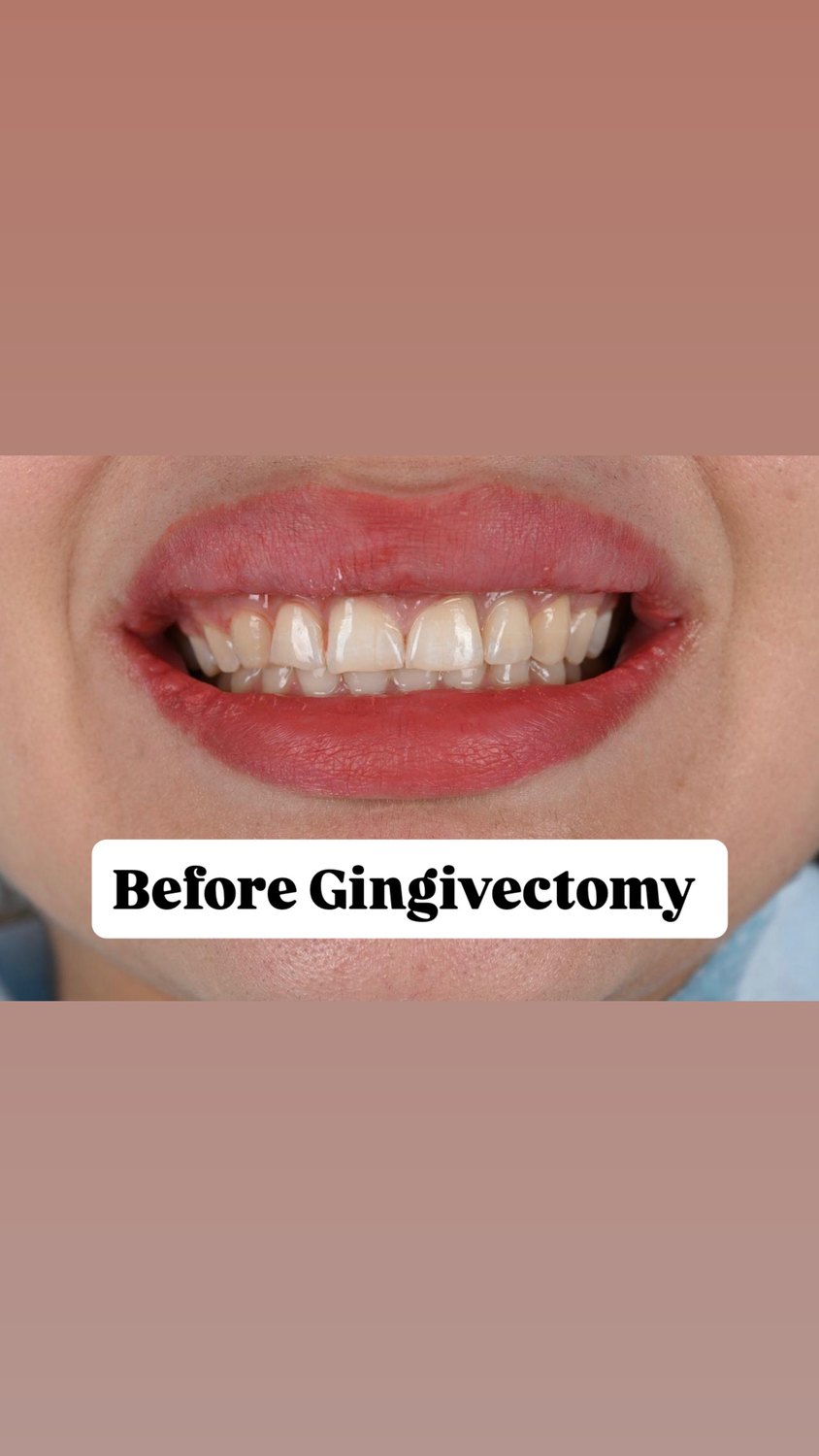 Before — Gingivectomy