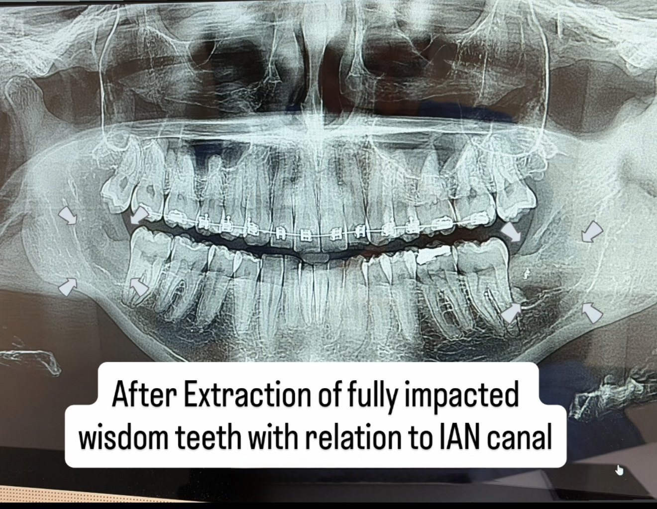 After — Extraction of fully impacted wisdom teeth in close relation to the IAN canal