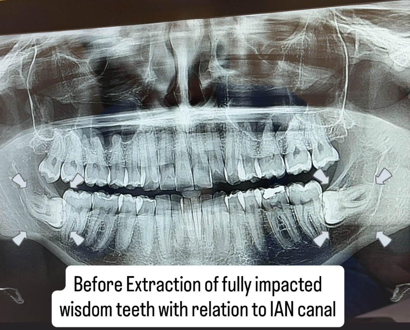 Before — Extraction of fully impacted wisdom teeth in close relation to the IAN canal