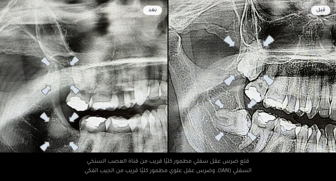 قبل وبعد — قلع ضرس عقل سفلي مطمور كليًا قريب من قناة العصب السنخي السفلي (IAN)، وضرس عقل علوي مطمور كليًا قريب من الجيب الفكي