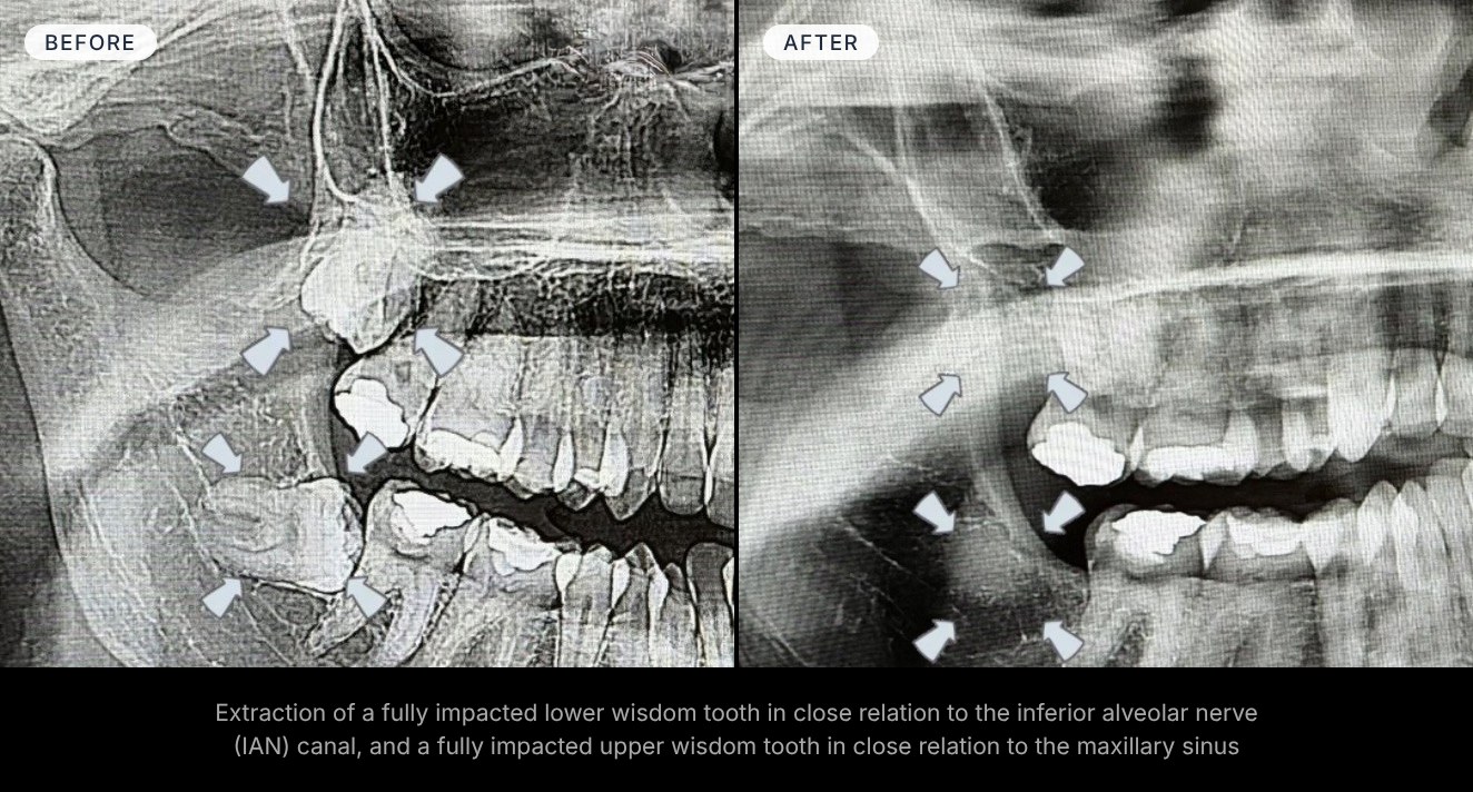 Before and after — Extraction of a fully impacted lower wisdom tooth in close relation to the inferior alveolar nerve (IAN) canal, and a fully impacted upper wisdom tooth in close relation to the maxillary sinus