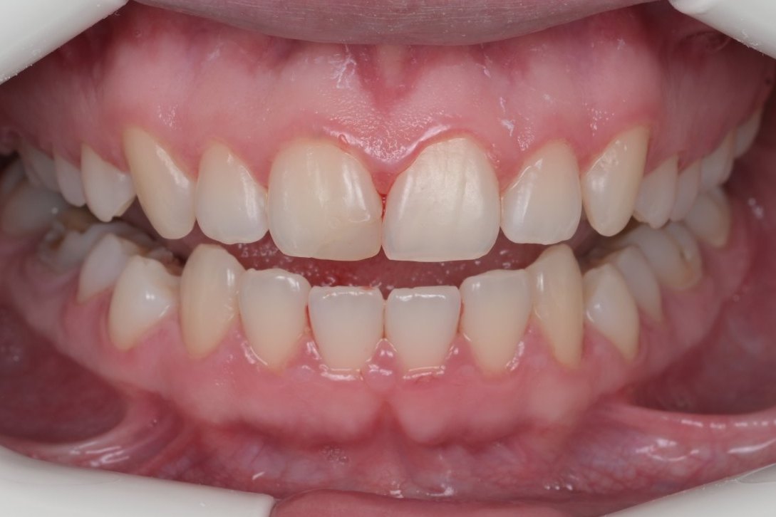 After GBT cleaning: clean teeth with the stains removed