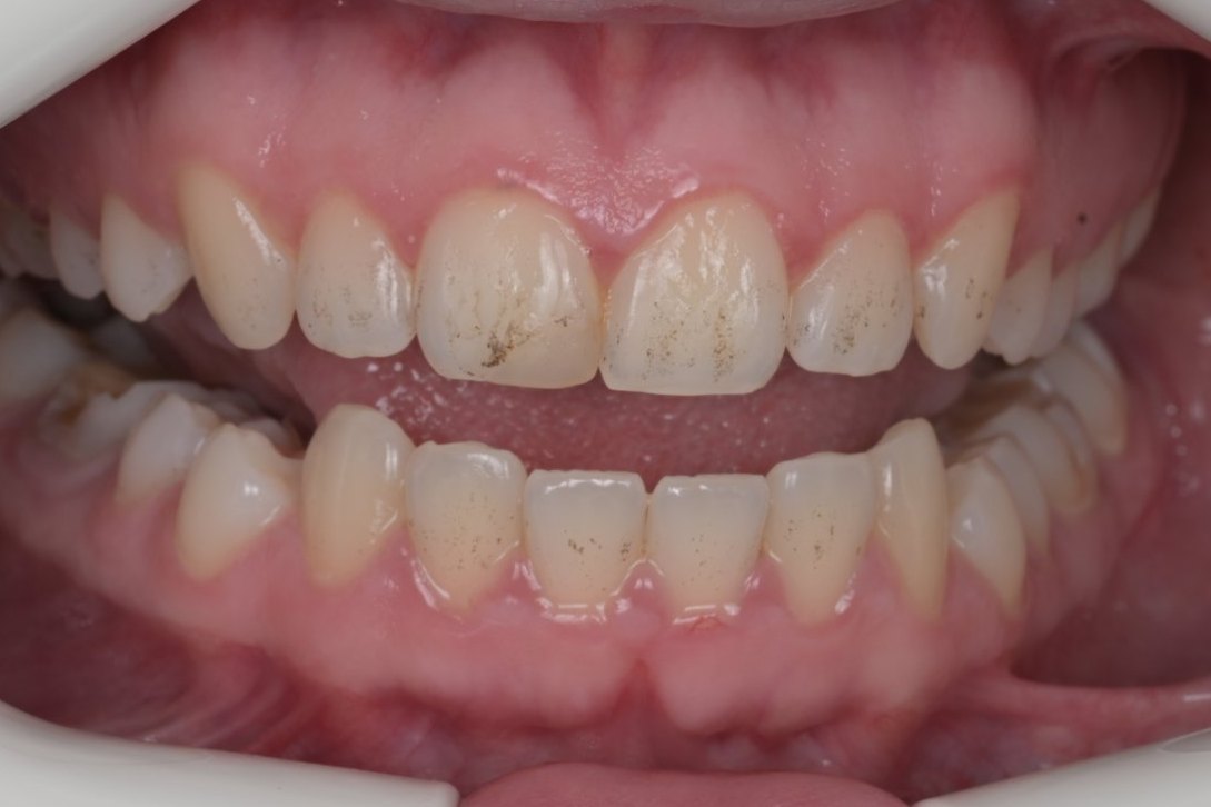 Before GBT cleaning: yellow and brown stains on the front teeth