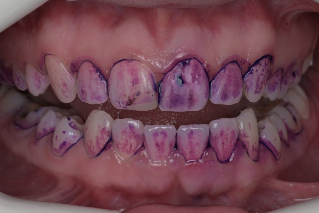 During GBT cleaning: a purple dye shows where plaque remains on the teeth