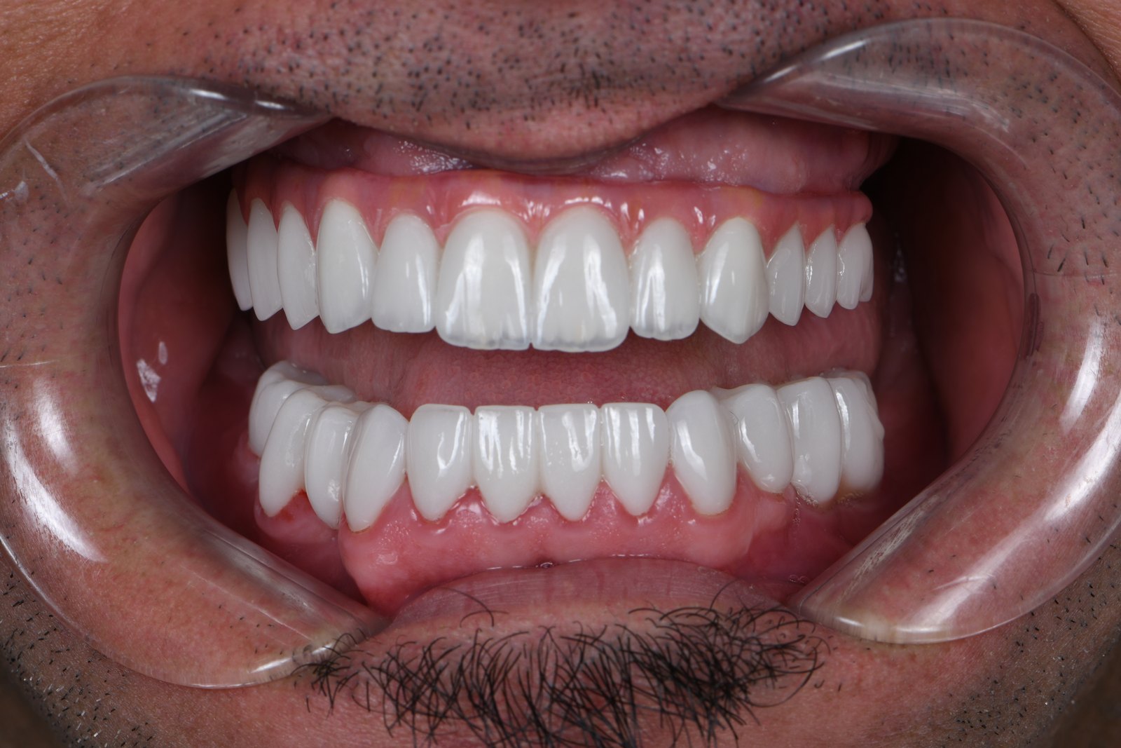 After — Full-arch implants (case 1)