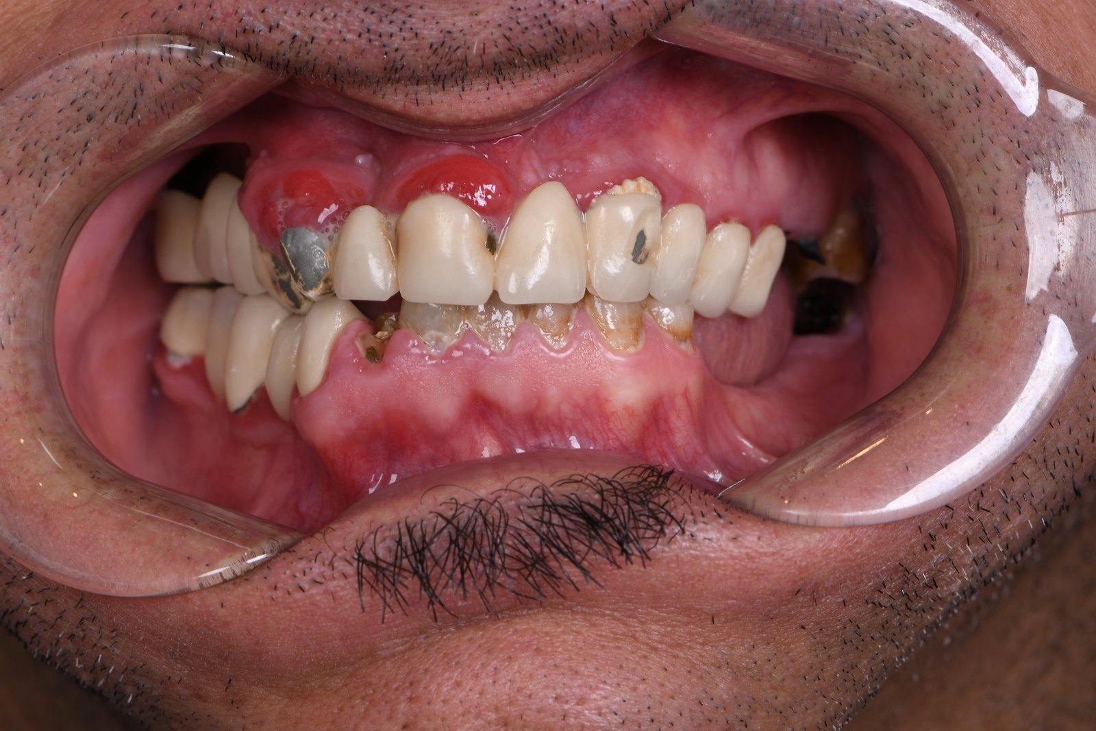 Before — Full-arch implants (case 1)