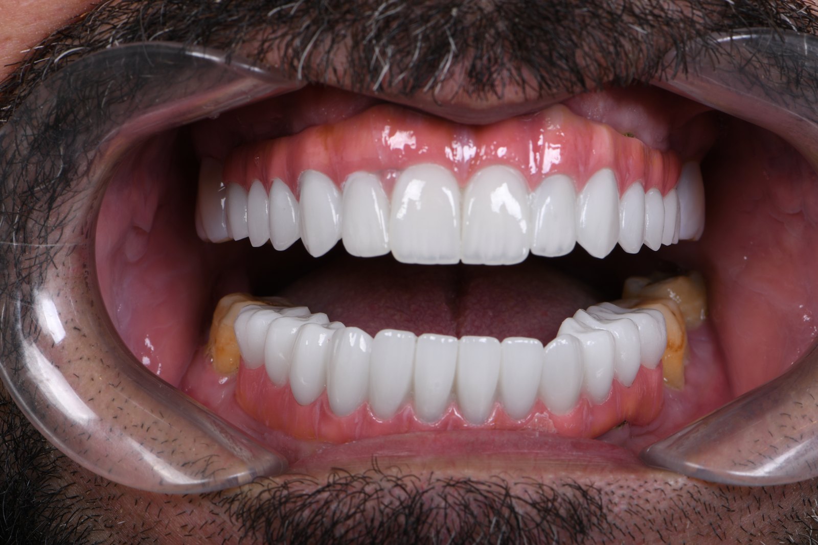 After — Full-arch implants (case 2)