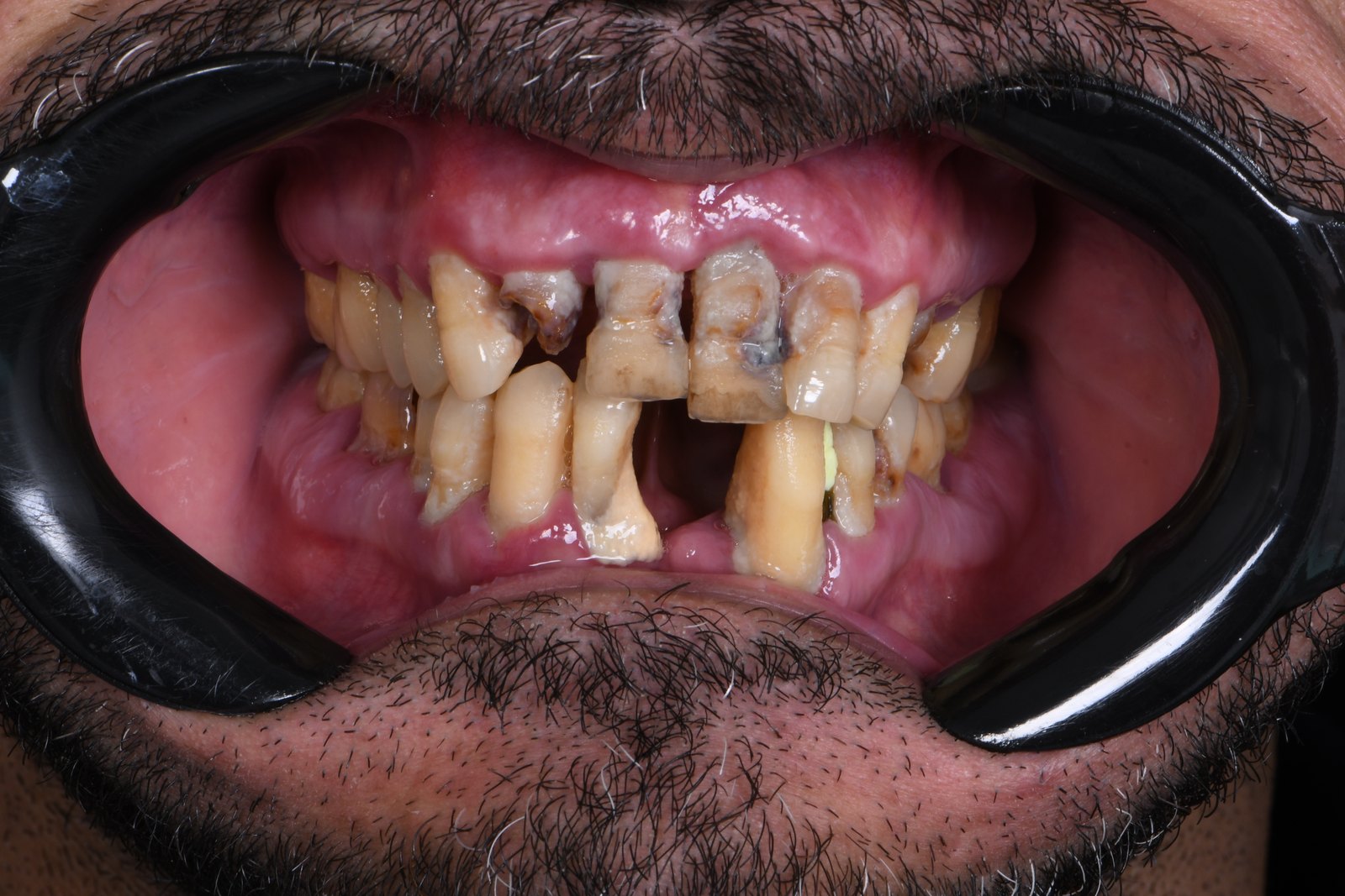 Before — Full-arch implants (case 2)