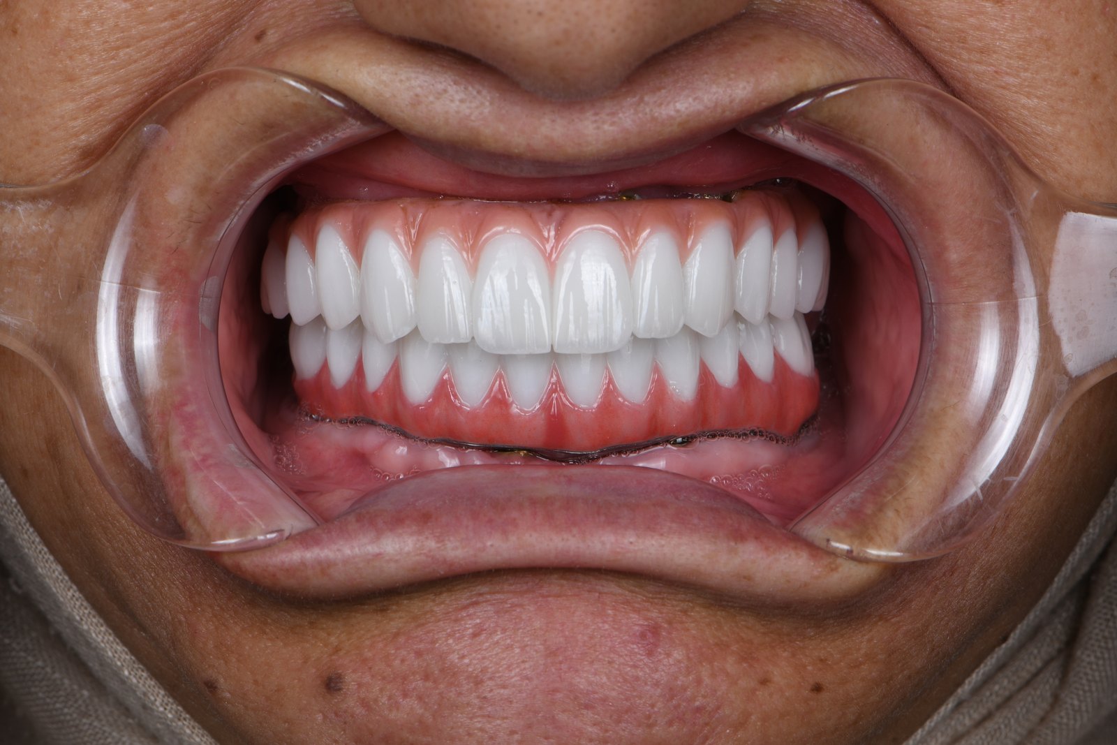After — Full-arch implants (case 3)