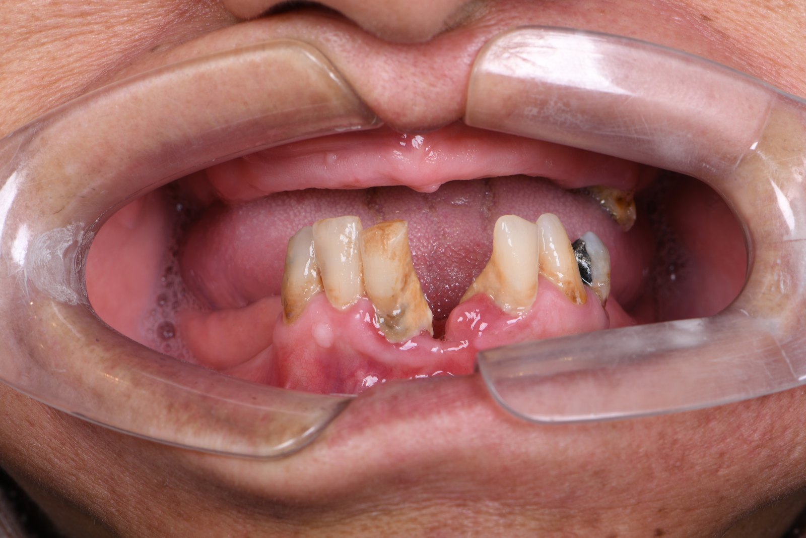 Before — Full-arch implants (case 3)