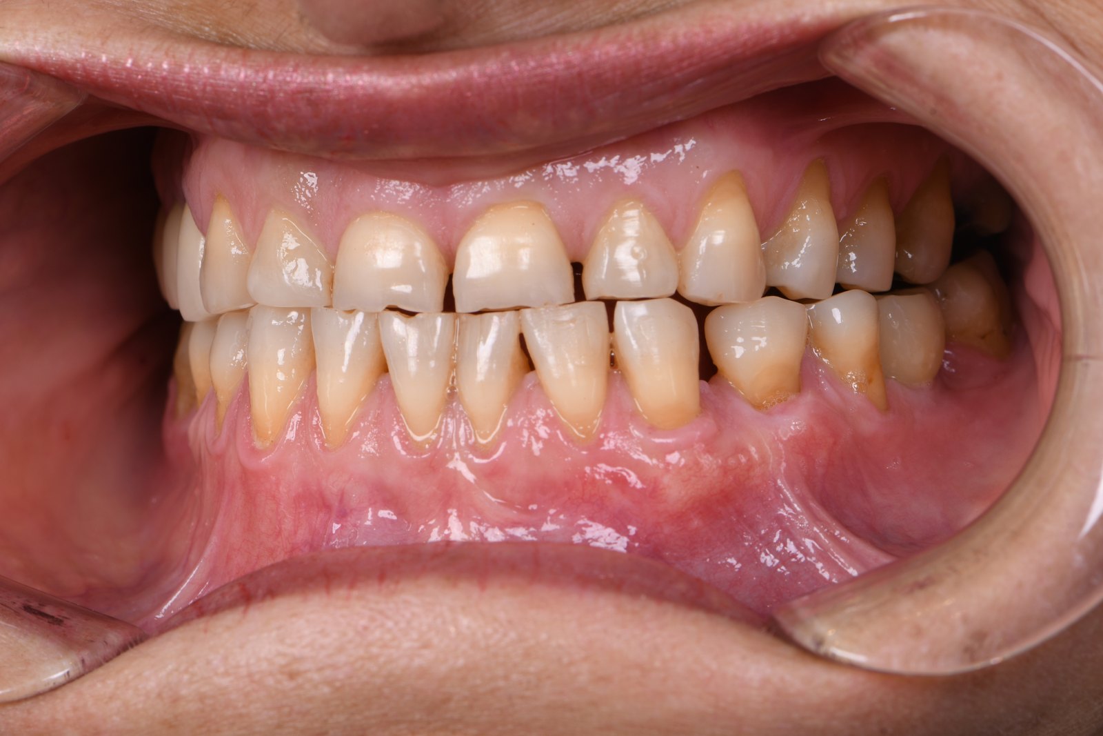 After — Gum graft (case 1)
