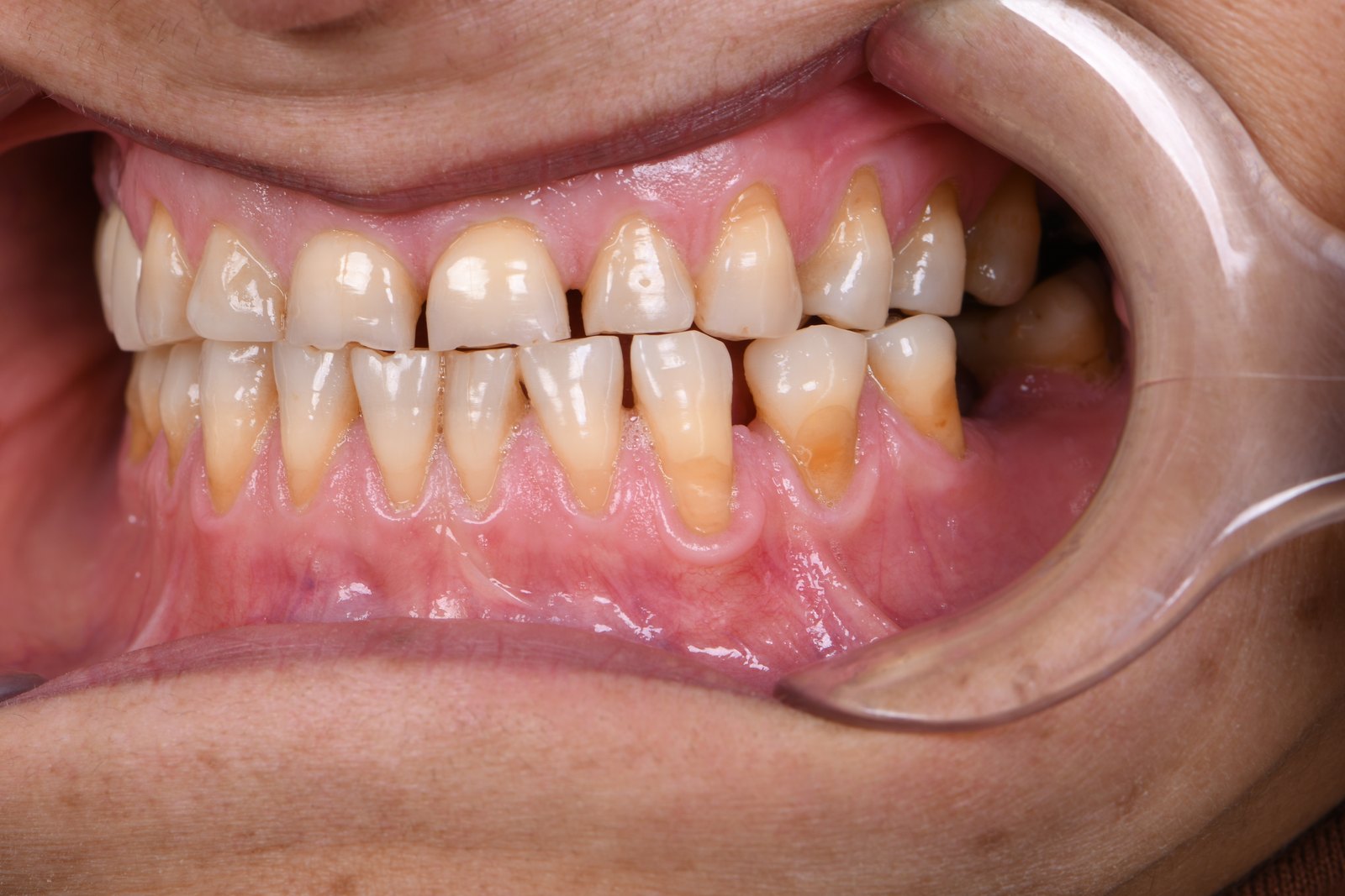 Before — Gum graft (case 1)