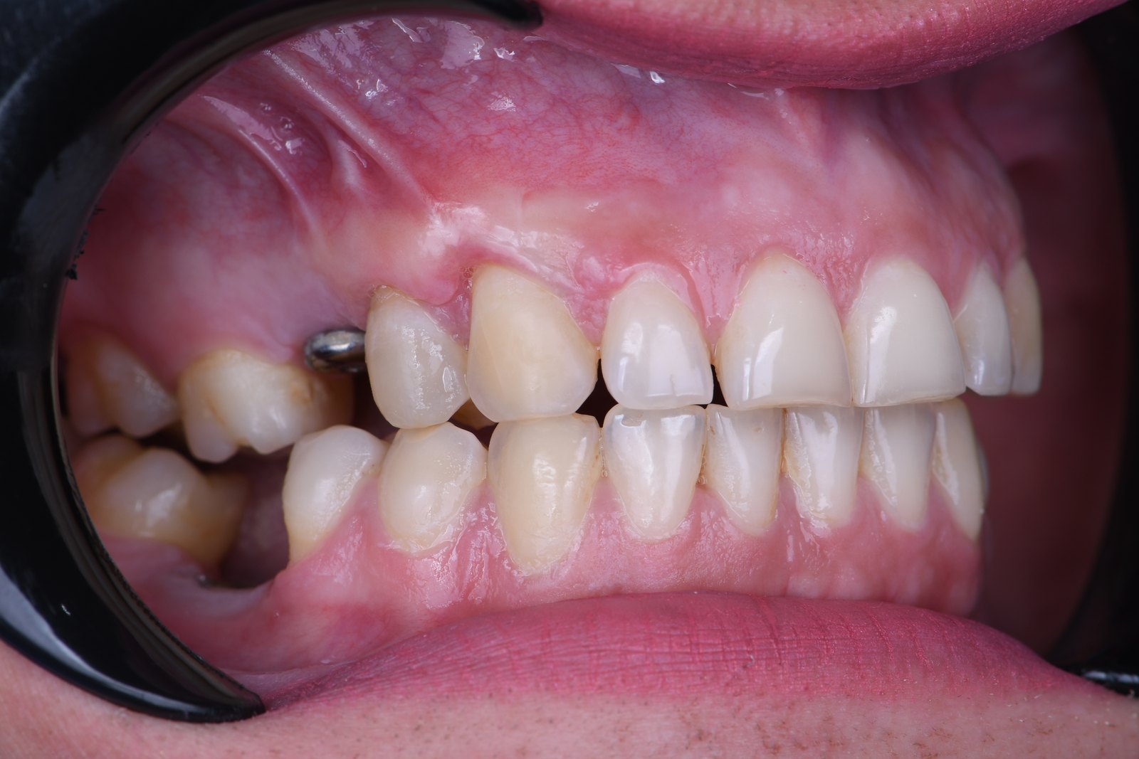 After — Gum graft (case 2)