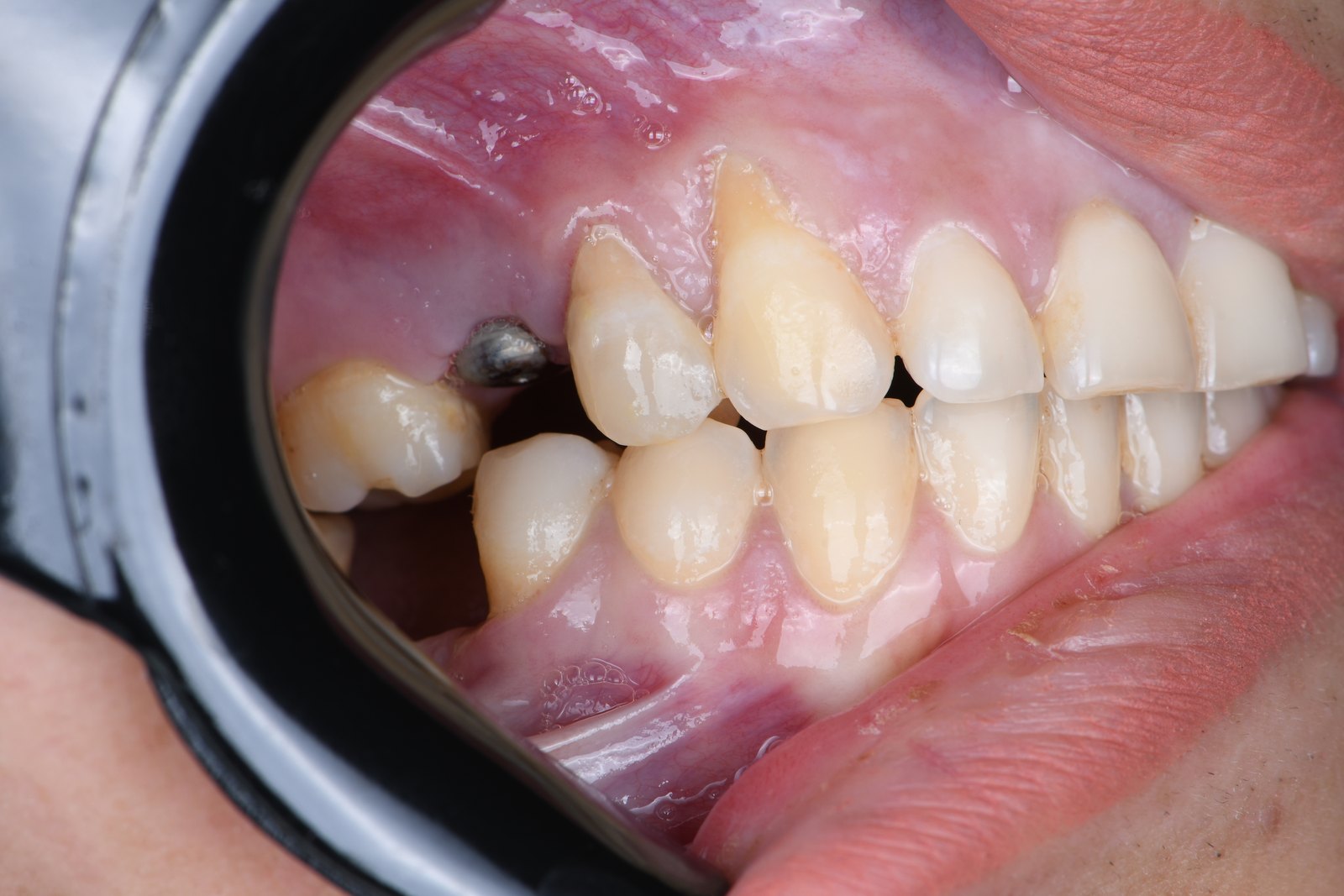 Before — Gum graft (case 2)