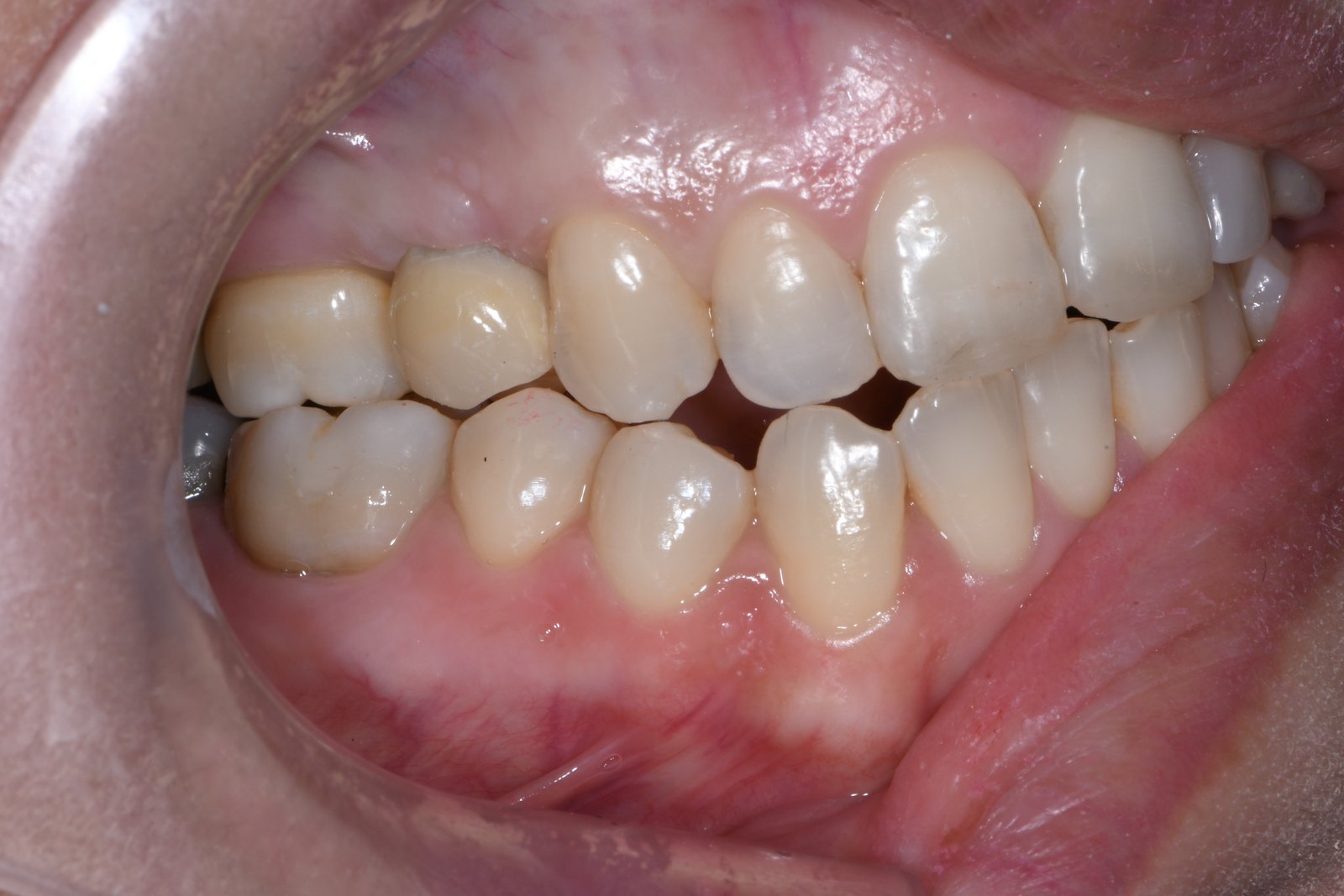 After — Single-tooth implant (case 1)
