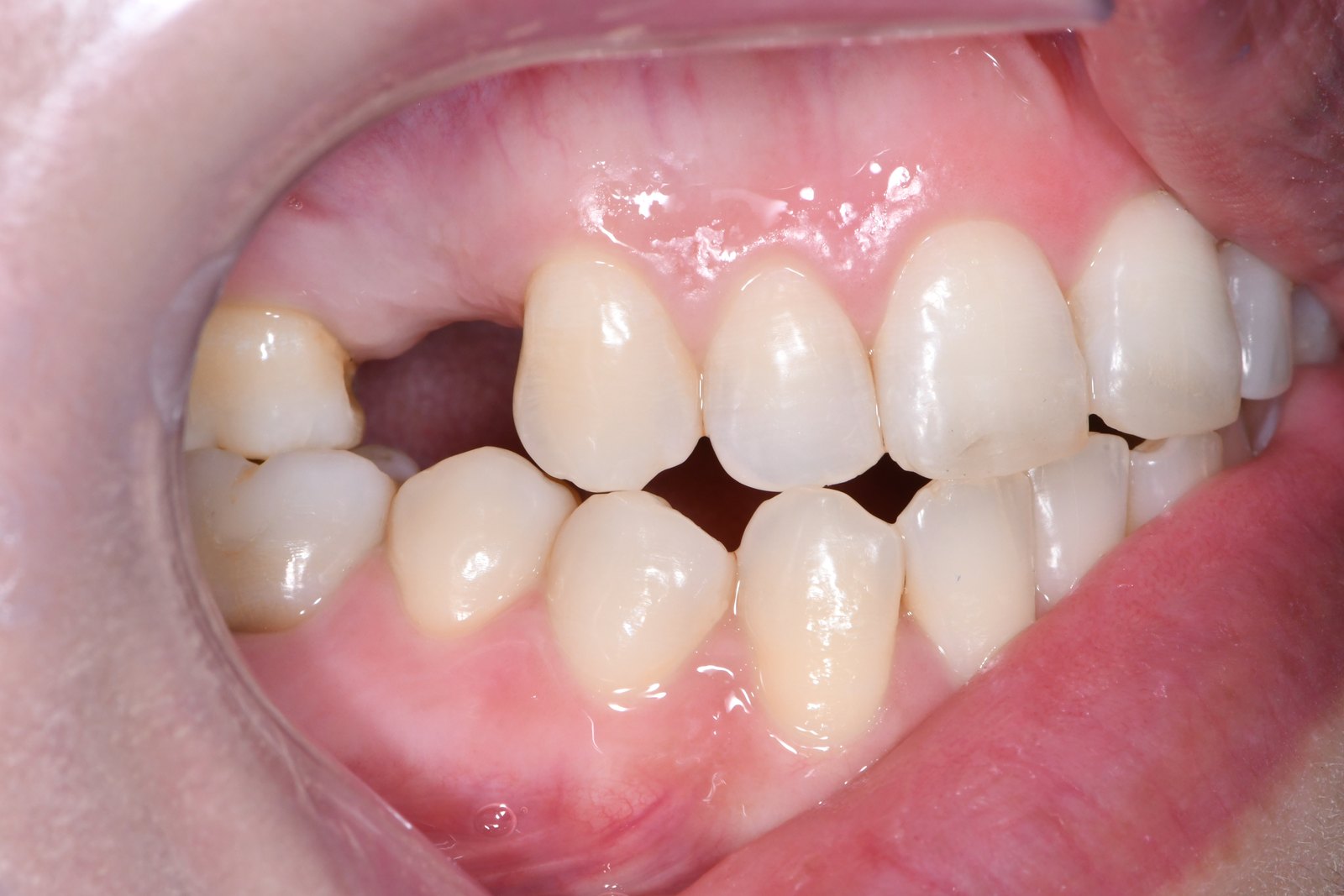 Before — Single-tooth implant (case 1)