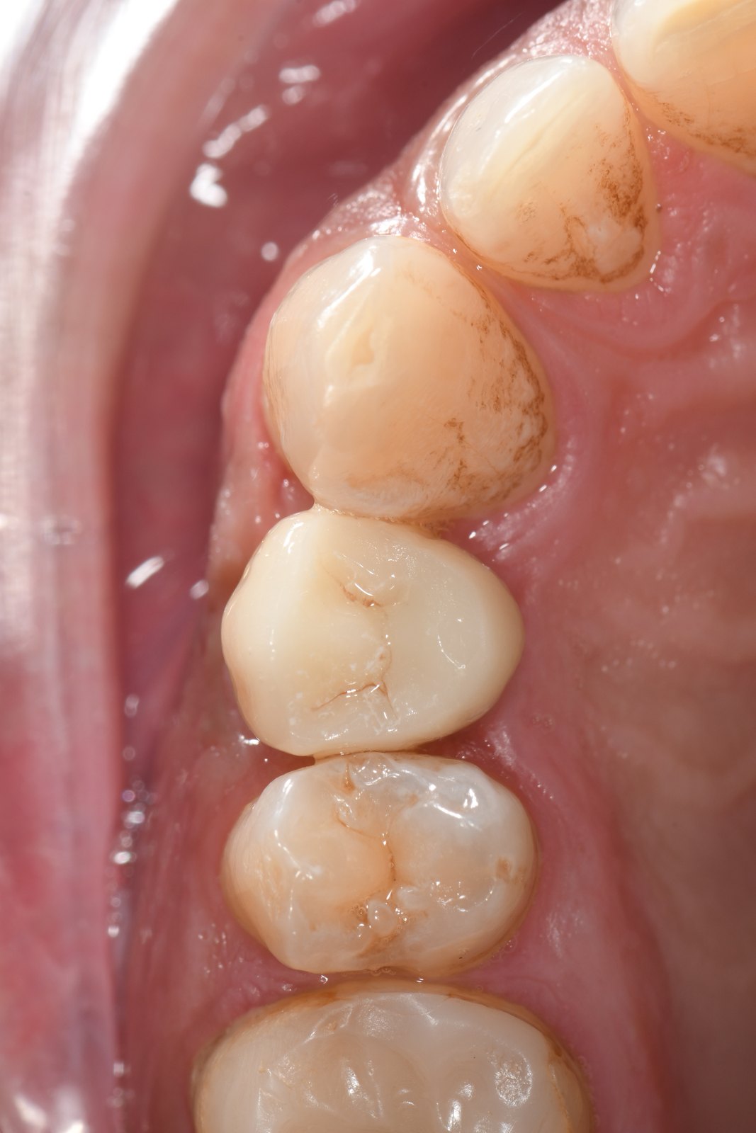After — Single-tooth implant (case 2)