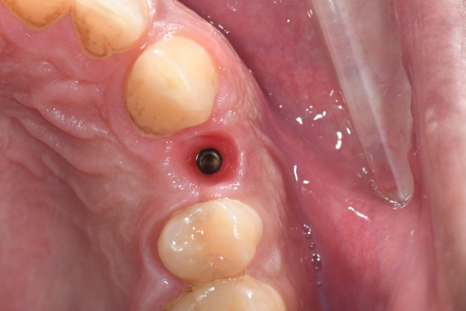 Before — Single-tooth implant (case 2)
