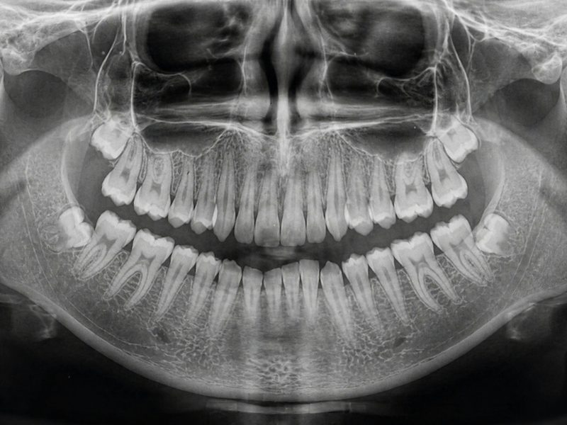 A panoramic dental X-ray showing all the teeth and both jaws