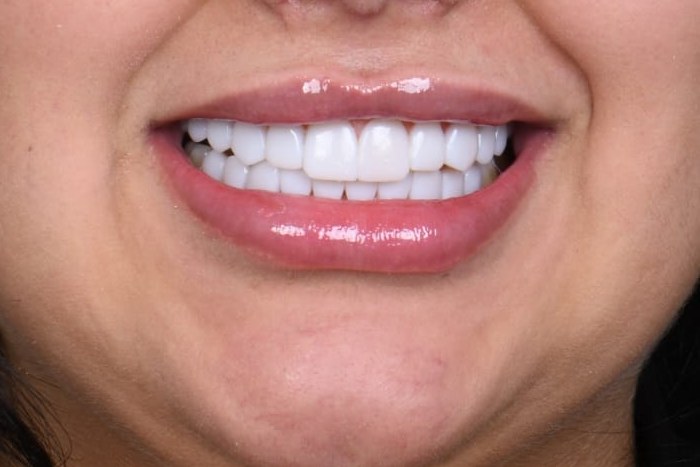 After treatment — Dr. Mohammed Al-Khfaje (case 2)