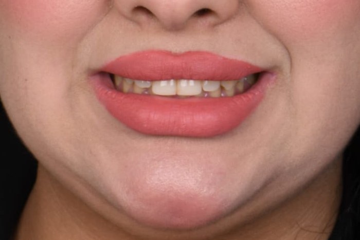 Before treatment — Dr. Mohammed Al-Khfaje (case 2)