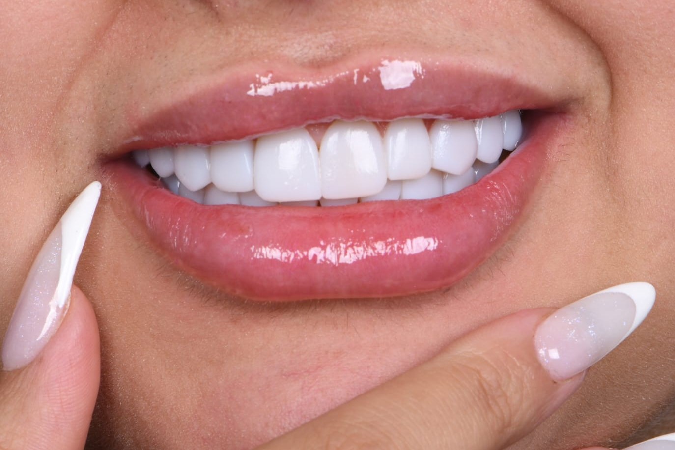 Completed smile — Dr. Mohammed Al-Khfaje