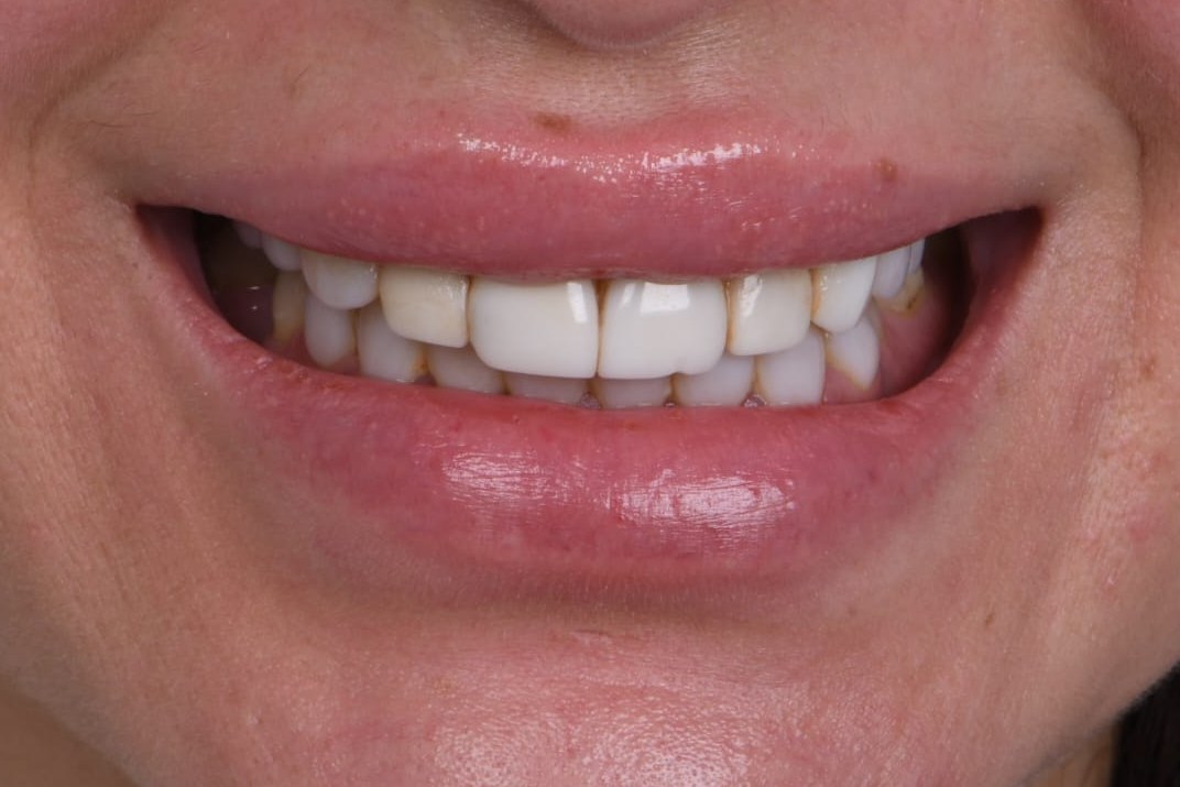 Before treatment — Dr. Mohammed Al-Khfaje (case 3)