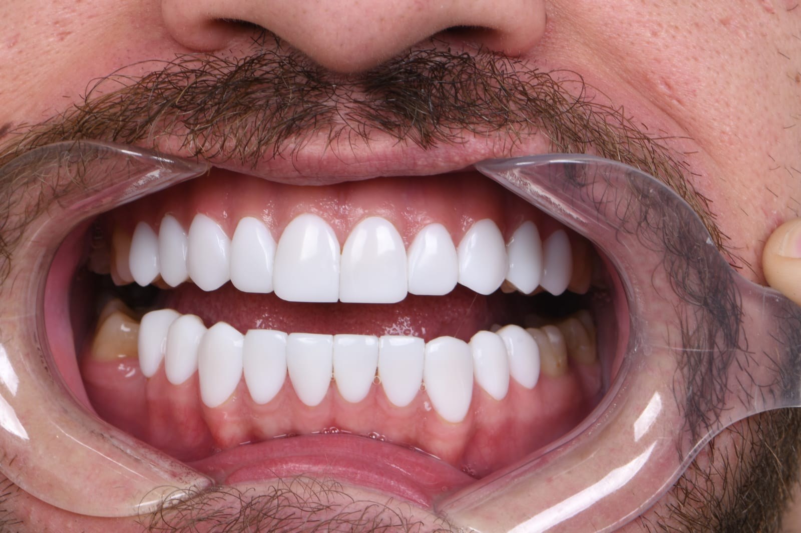 After treatment — Dr. Mohammed Al-Khfaje (case 4)