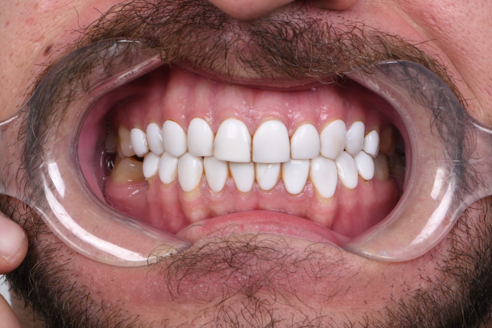 Before treatment — Dr. Mohammed Al-Khfaje (case 4)