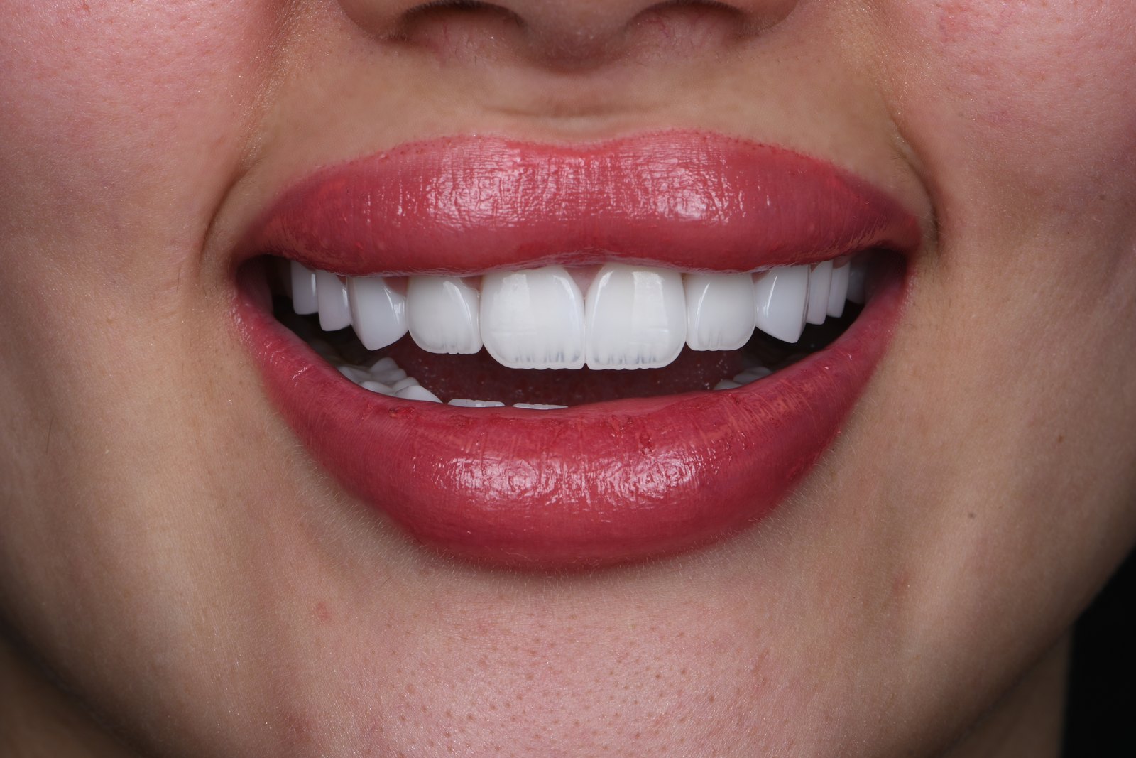 Completed smile