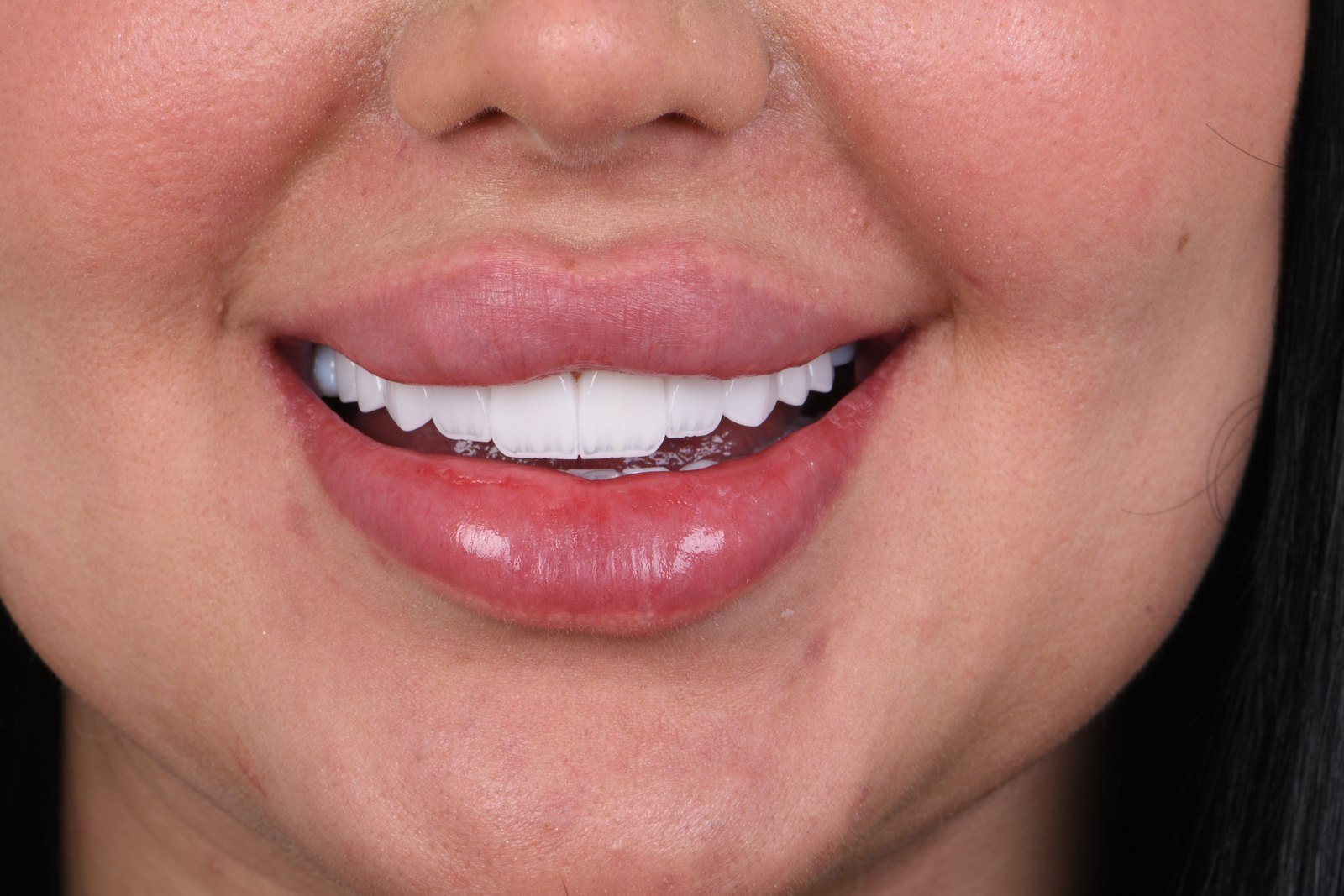 Completed smile