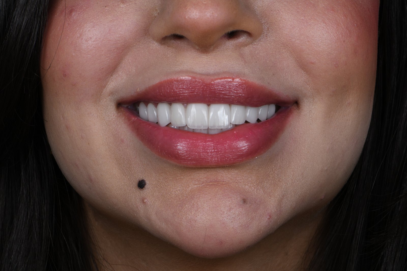 Completed smile