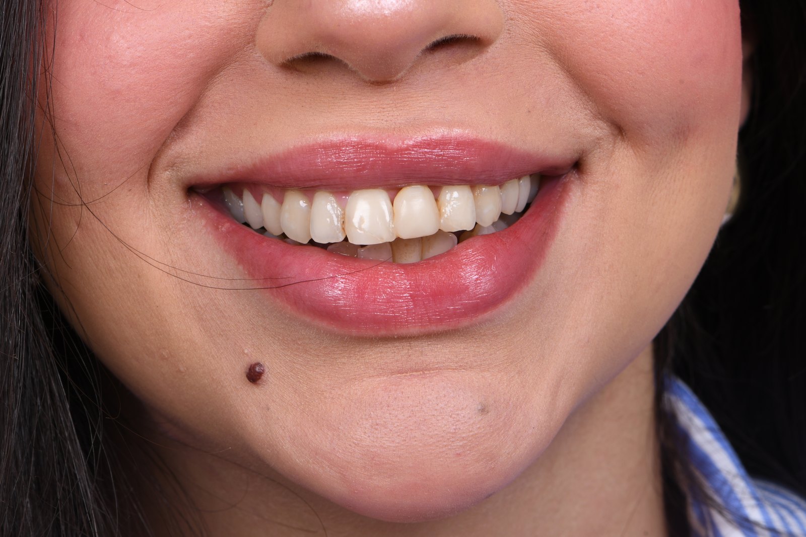 Before treatment — case 2
