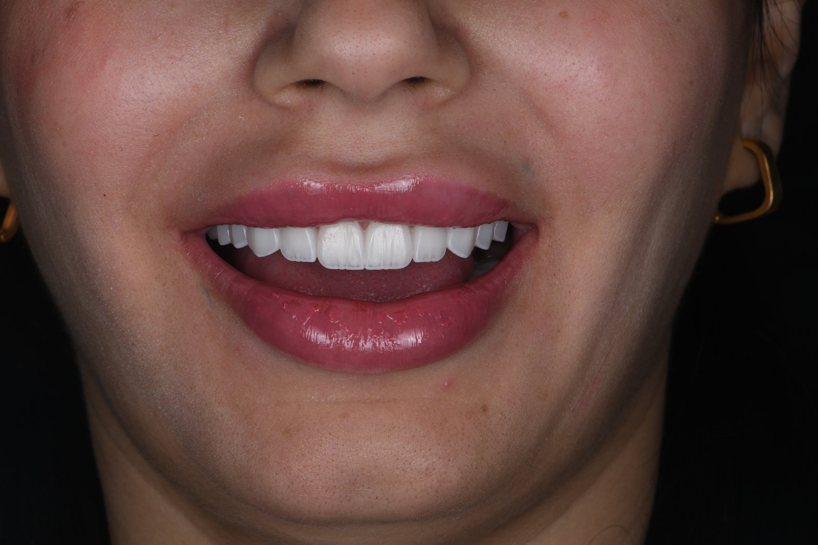 Completed smile