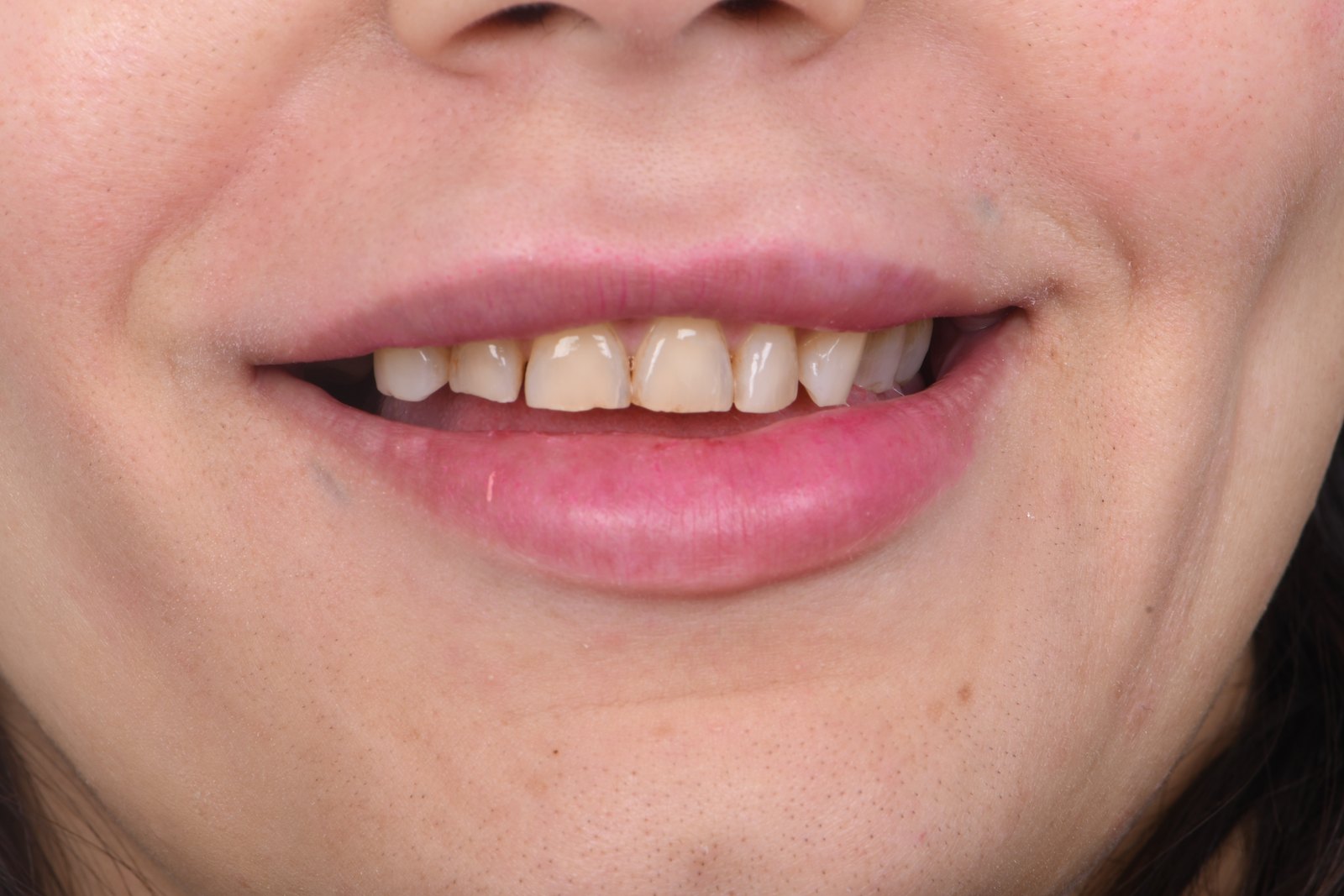 Before treatment — case 3